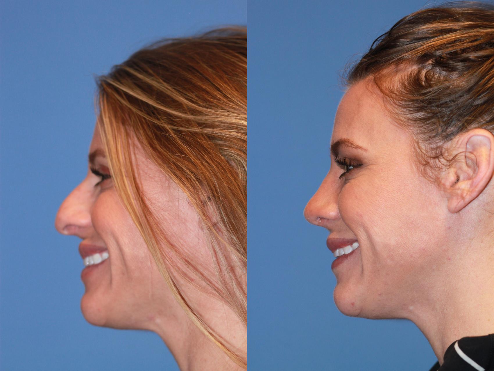 Before & After Rhinoplasty Case 170 View #3 View in Scottsdale, AZ