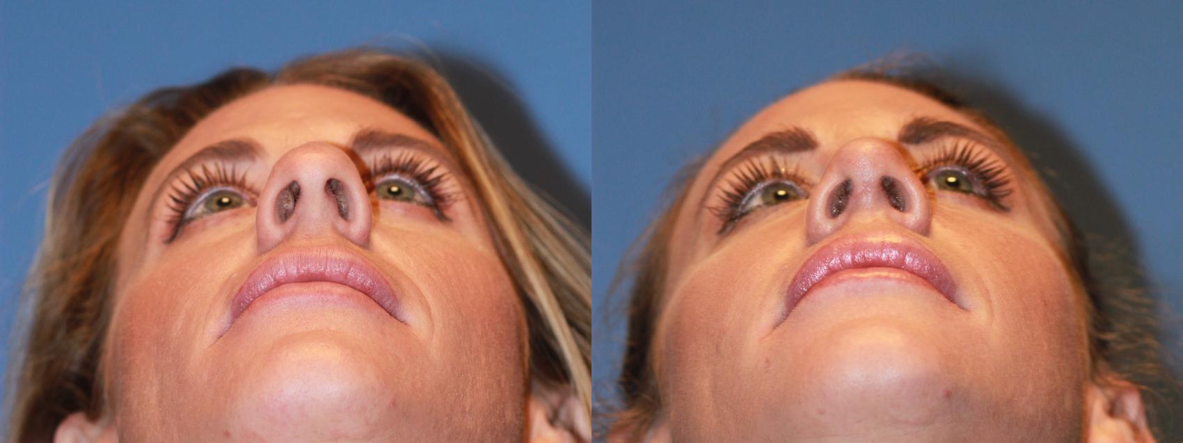 Before & After Rhinoplasty Case 170 View #4 View in Scottsdale, AZ
