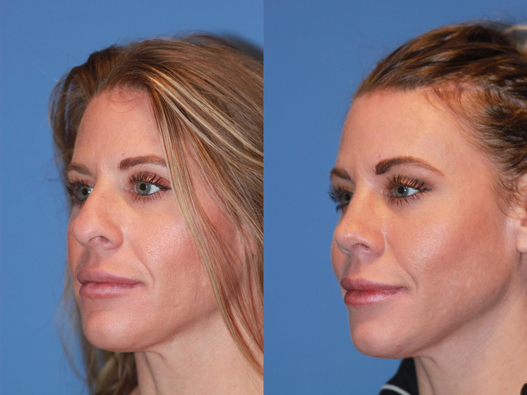Before & After Rhinoplasty Case 170 View #5 View in Scottsdale, AZ