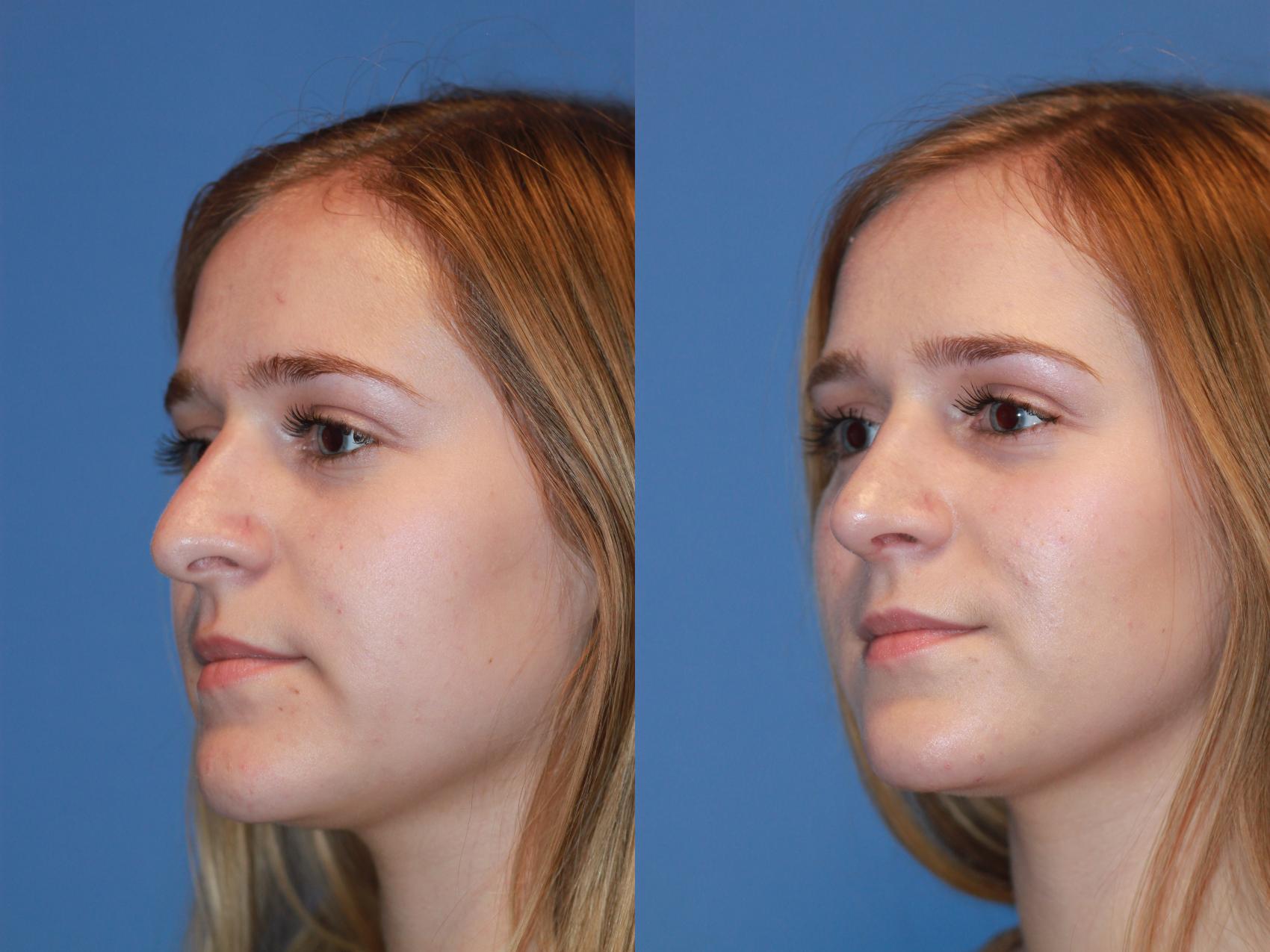 Before & After Rhinoplasty Case 171 View #2 View in Scottsdale, AZ