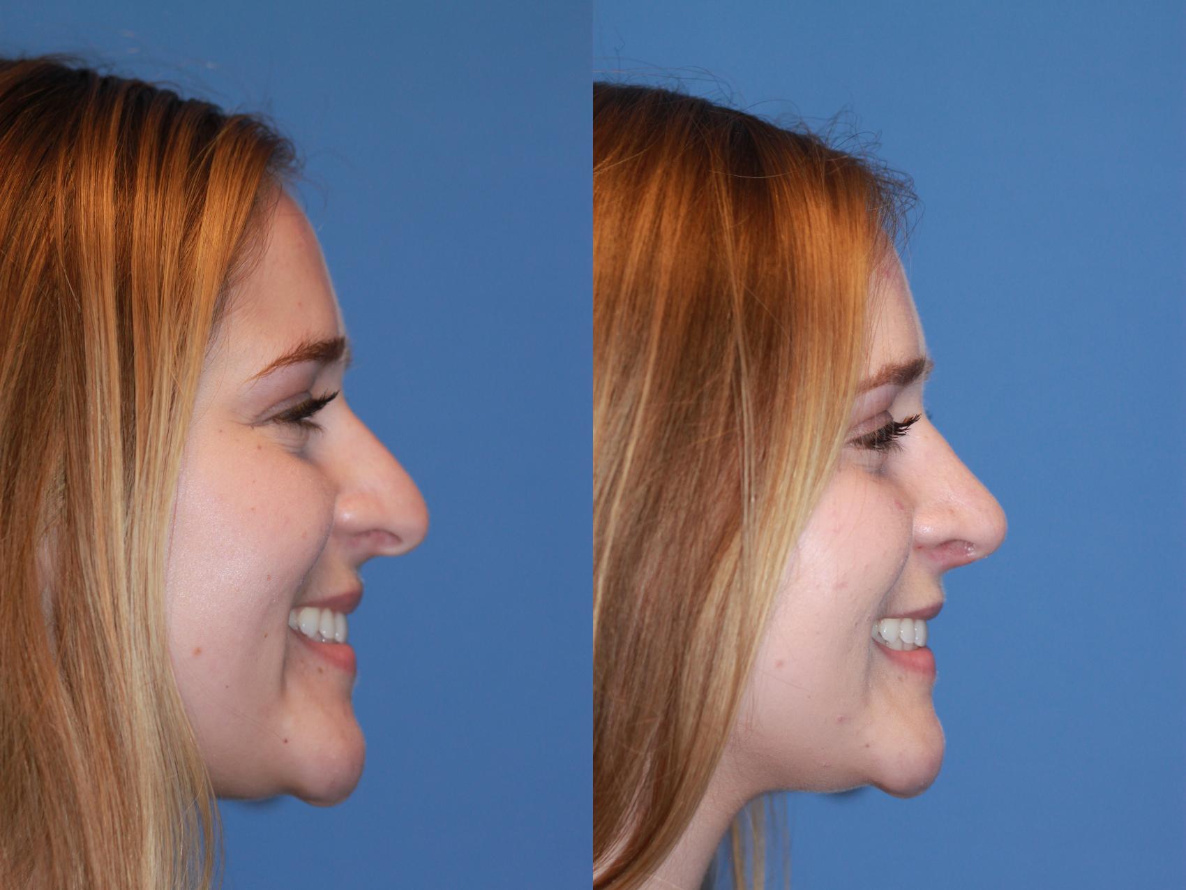 Before & After Rhinoplasty Case 171 View #3 View in Scottsdale, AZ