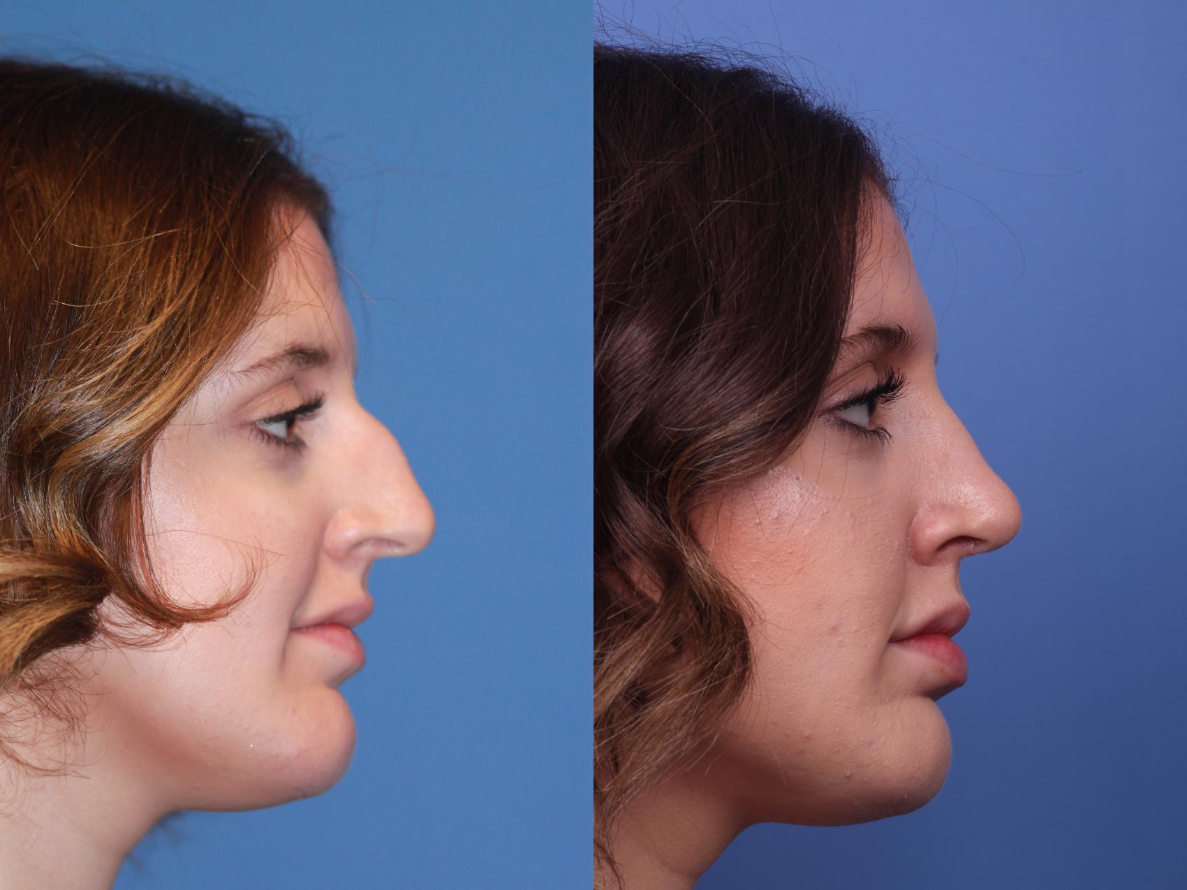 Before & After Rhinoplasty Case 174 View #2 View in Scottsdale, AZ