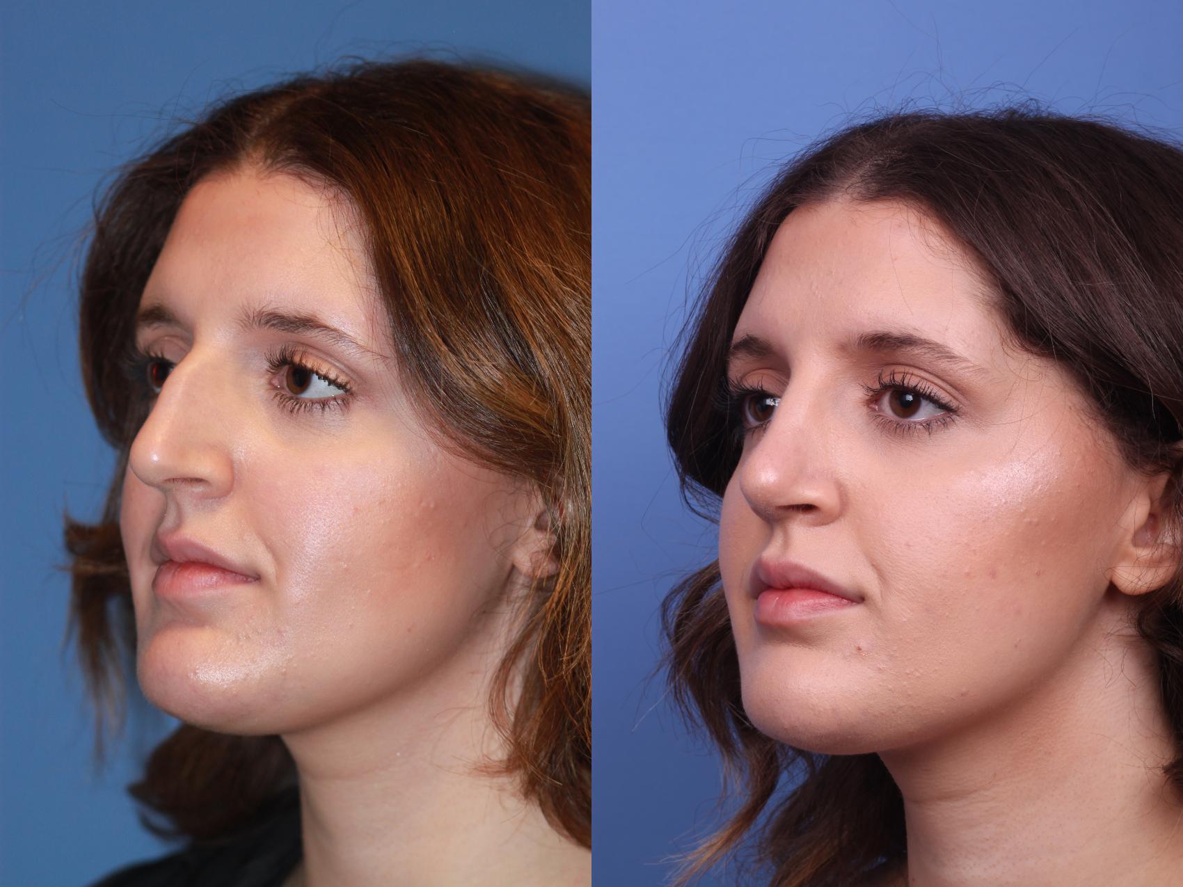 Before & After Rhinoplasty Case 174 View #3 View in Scottsdale, AZ