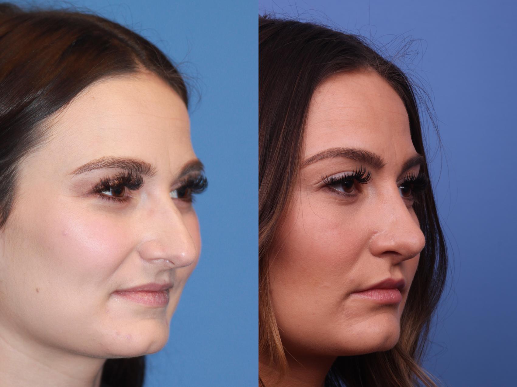 Before & After Rhinoplasty Case 175 View #2 View in Scottsdale, AZ