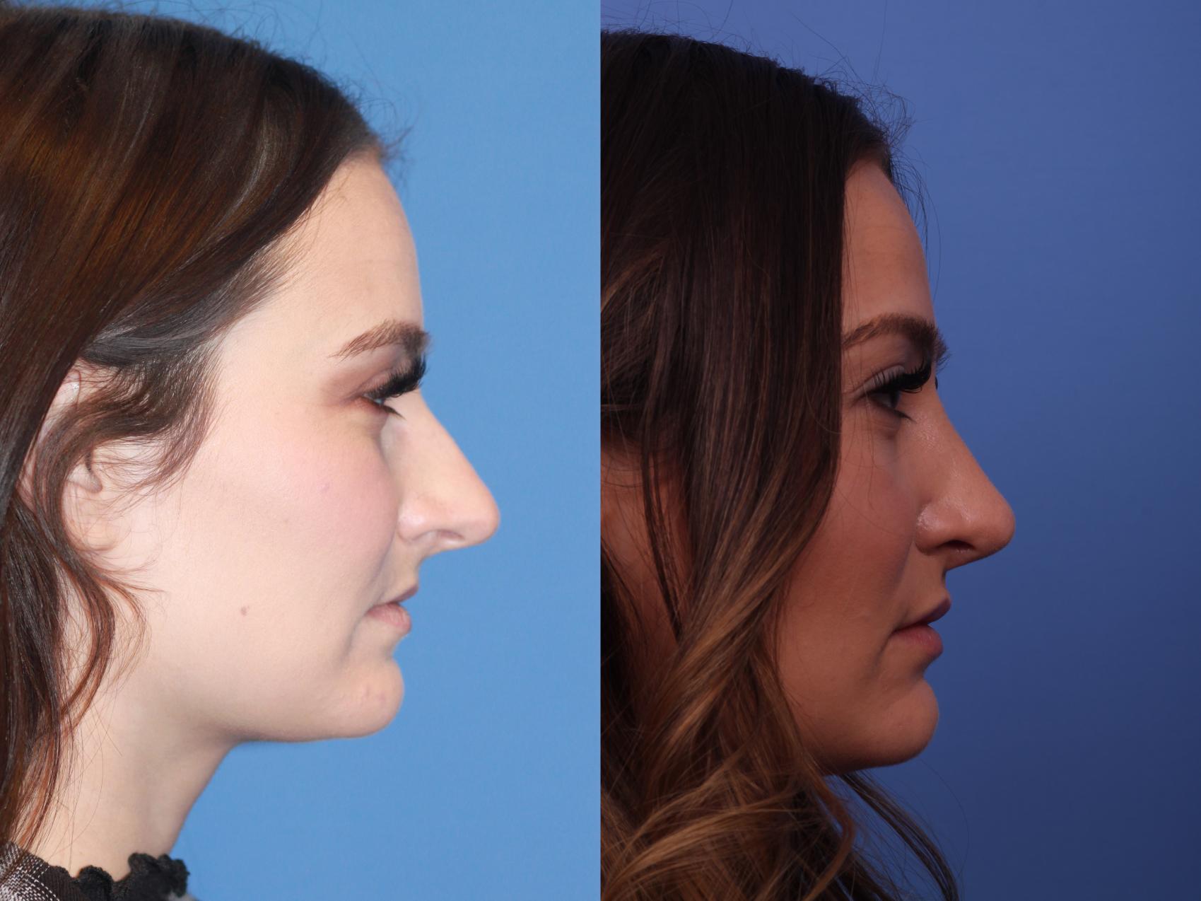 Before & After Rhinoplasty Case 175 View #3 View in Scottsdale, AZ