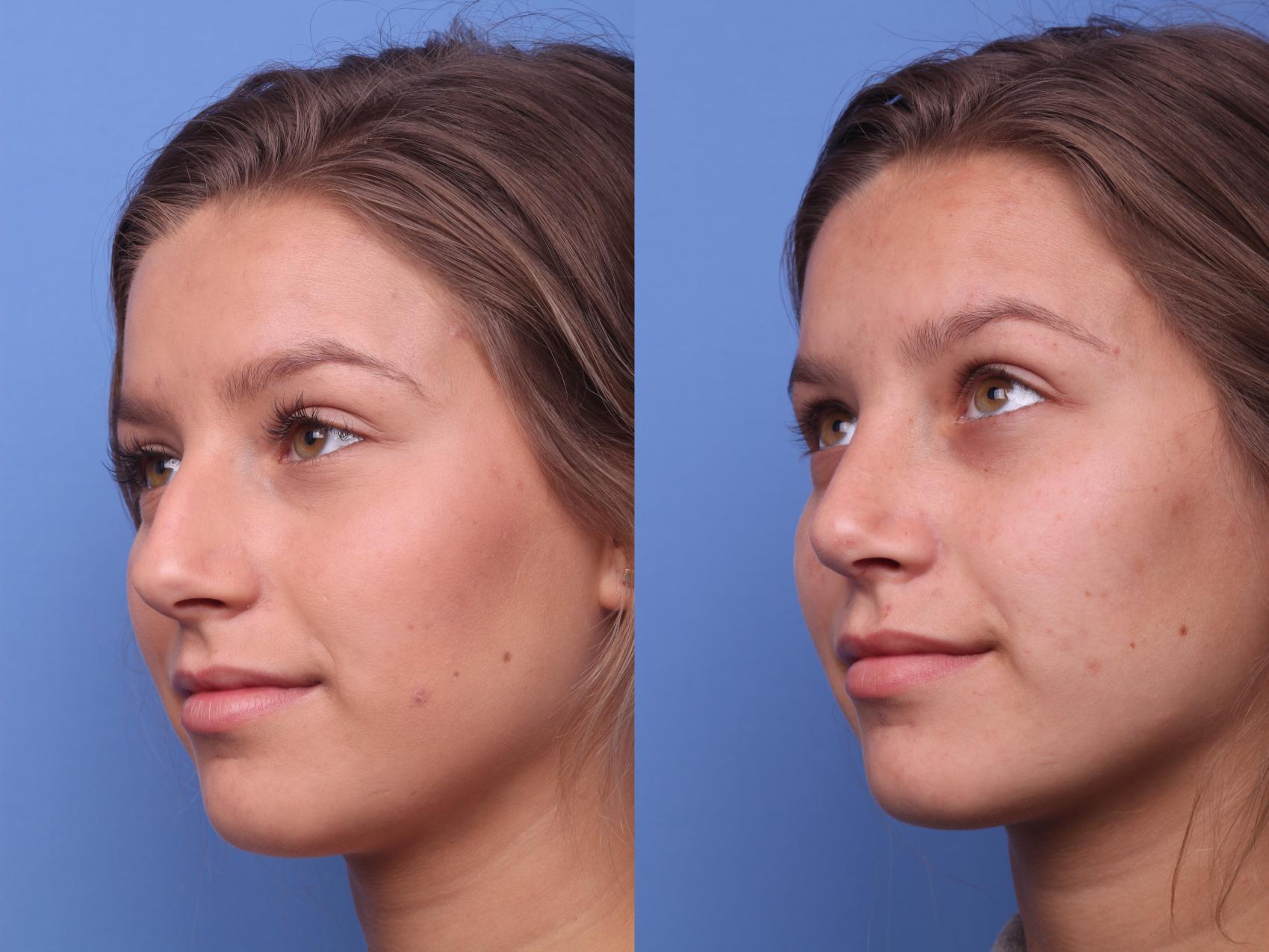 Before & After Rhinoplasty Case 177 View #2 View in Scottsdale, AZ