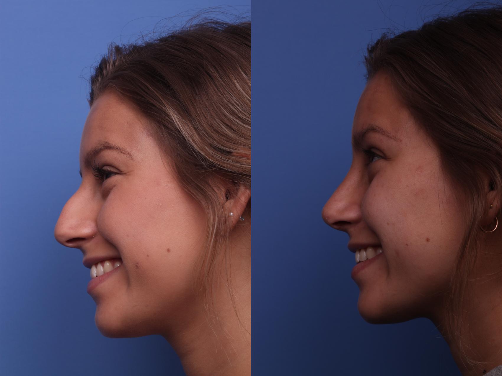 Before & After Rhinoplasty Case 177 View #3 View in Scottsdale, AZ