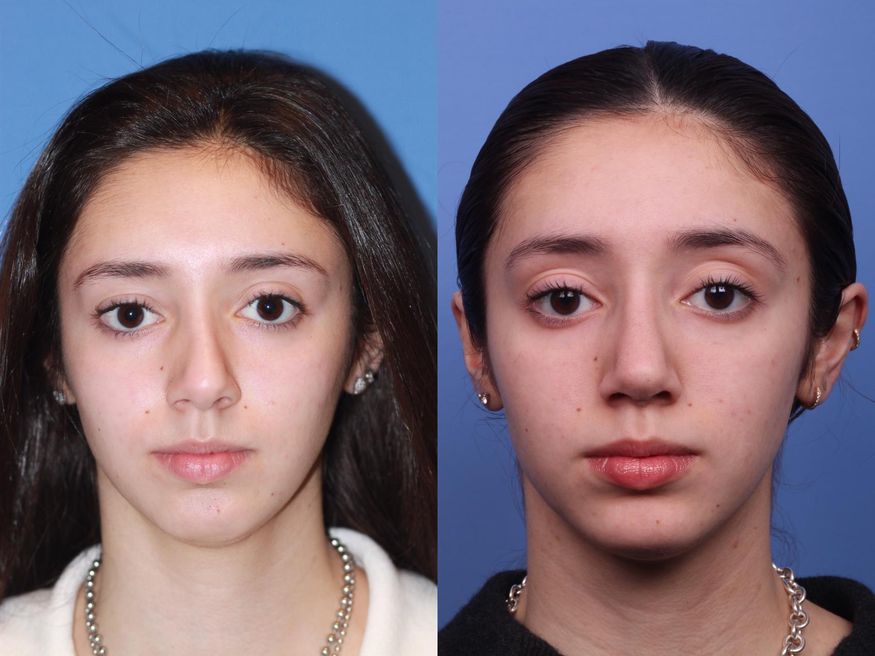 Before & After Rhinoplasty Case 178 View #1 View in Scottsdale, AZ