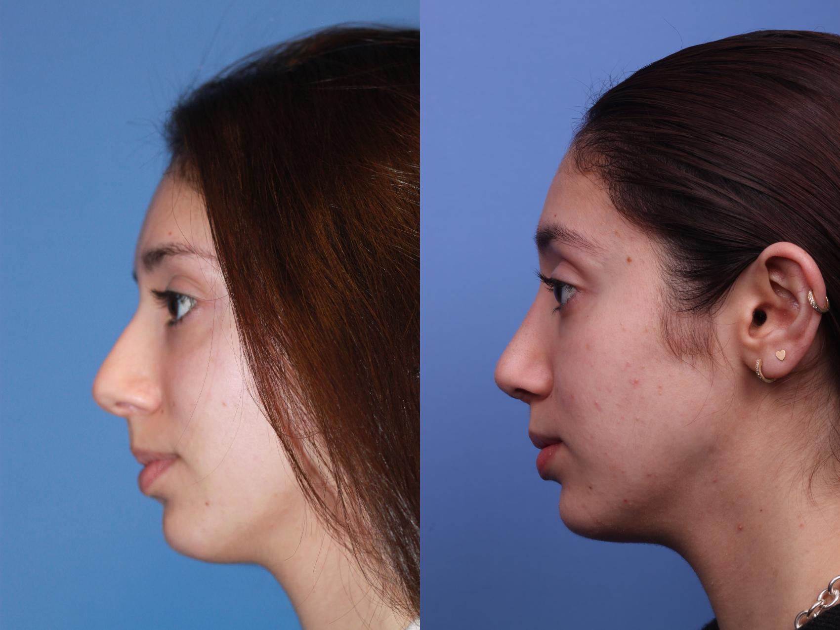 Before & After Rhinoplasty Case 178 View #2 View in Scottsdale, AZ