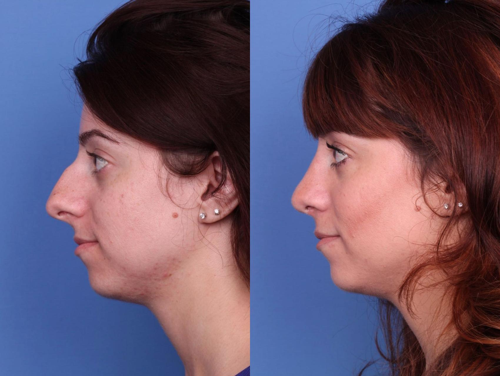 Before & After Rhinoplasty Case 18 View #2 View in Scottsdale, AZ