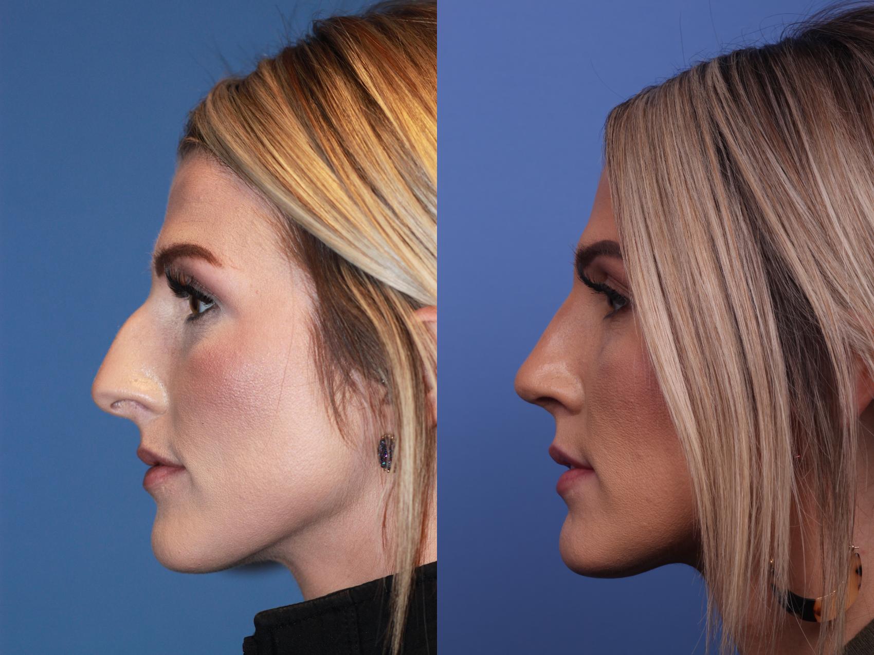 Before & After Rhinoplasty Case 182 View #2 View in Scottsdale, AZ