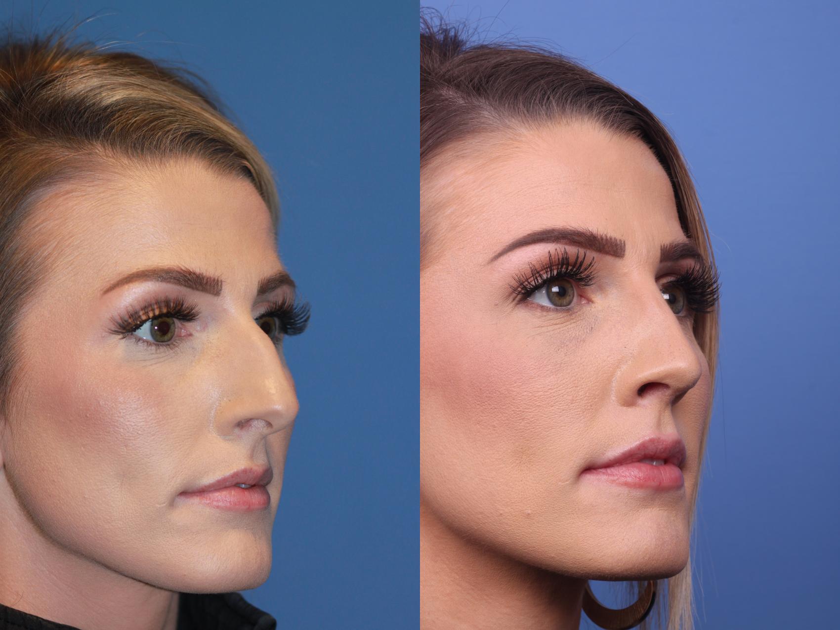 Before & After Rhinoplasty Case 182 View #3 View in Scottsdale, AZ
