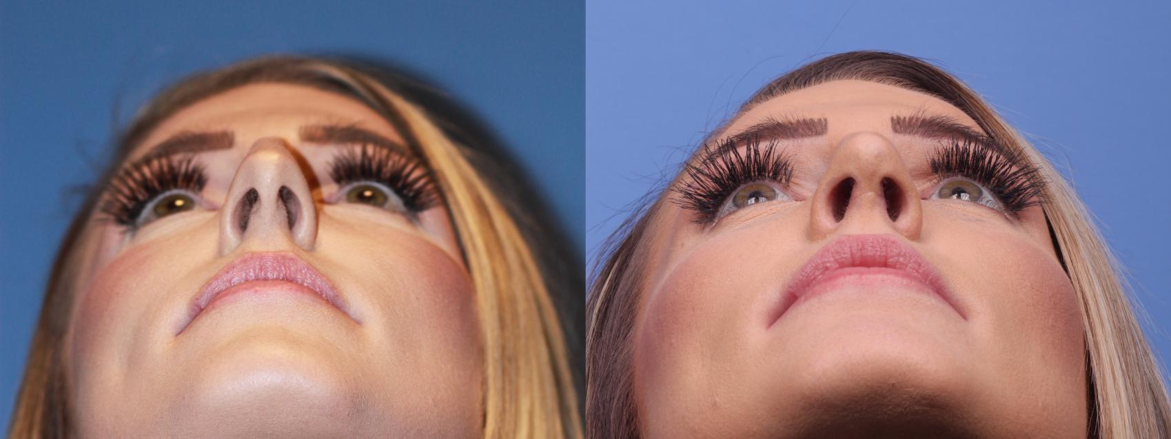Before & After Rhinoplasty Case 182 View #4 View in Scottsdale, AZ