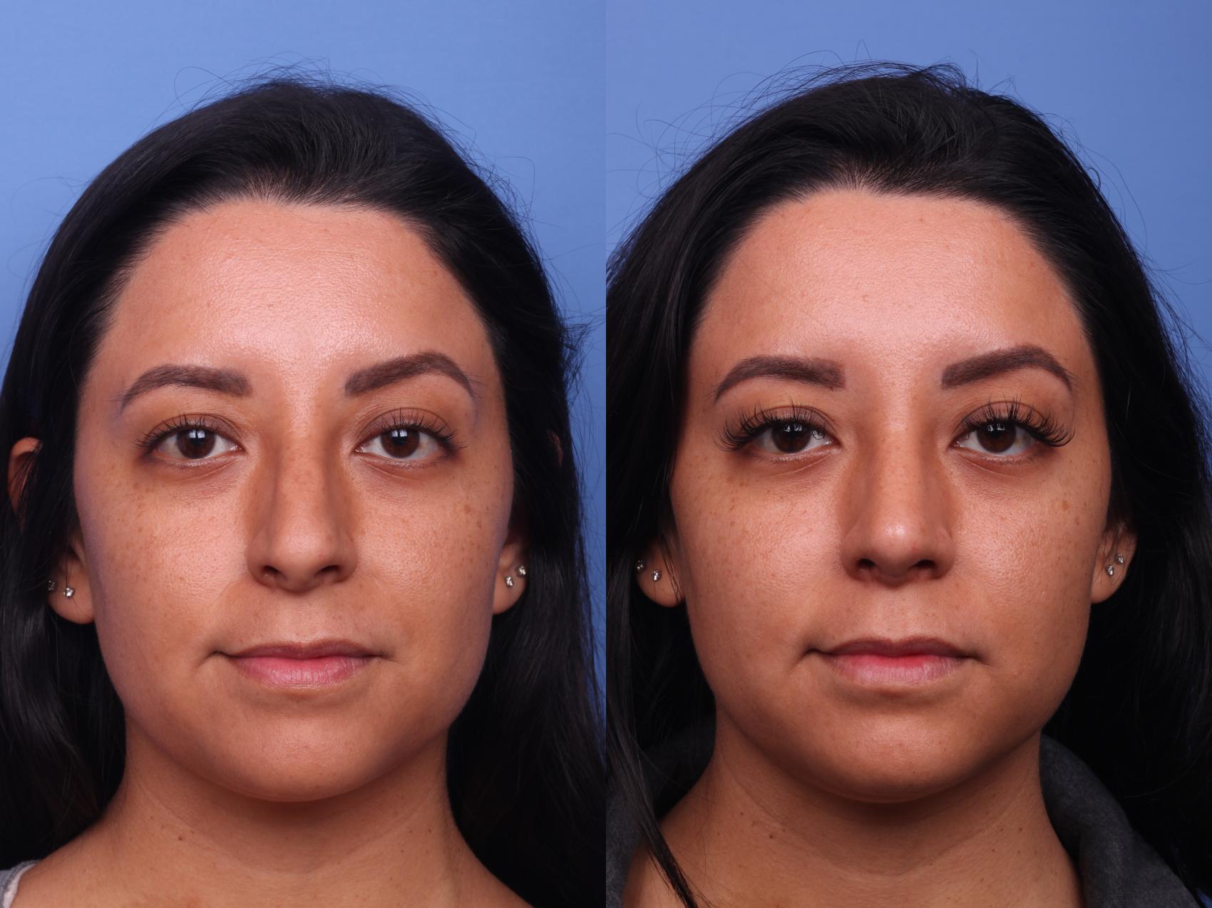 Before & After Rhinoplasty Case 185 View #2 View in Scottsdale, AZ