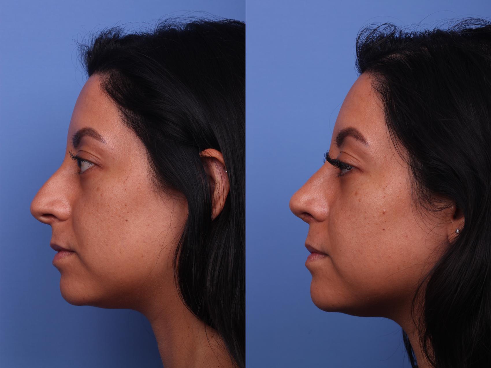 Before & After Rhinoplasty Case 185 View #3 View in Scottsdale, AZ