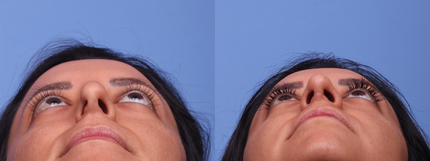 Before & After Rhinoplasty Case 185 View #4 View in Scottsdale, AZ