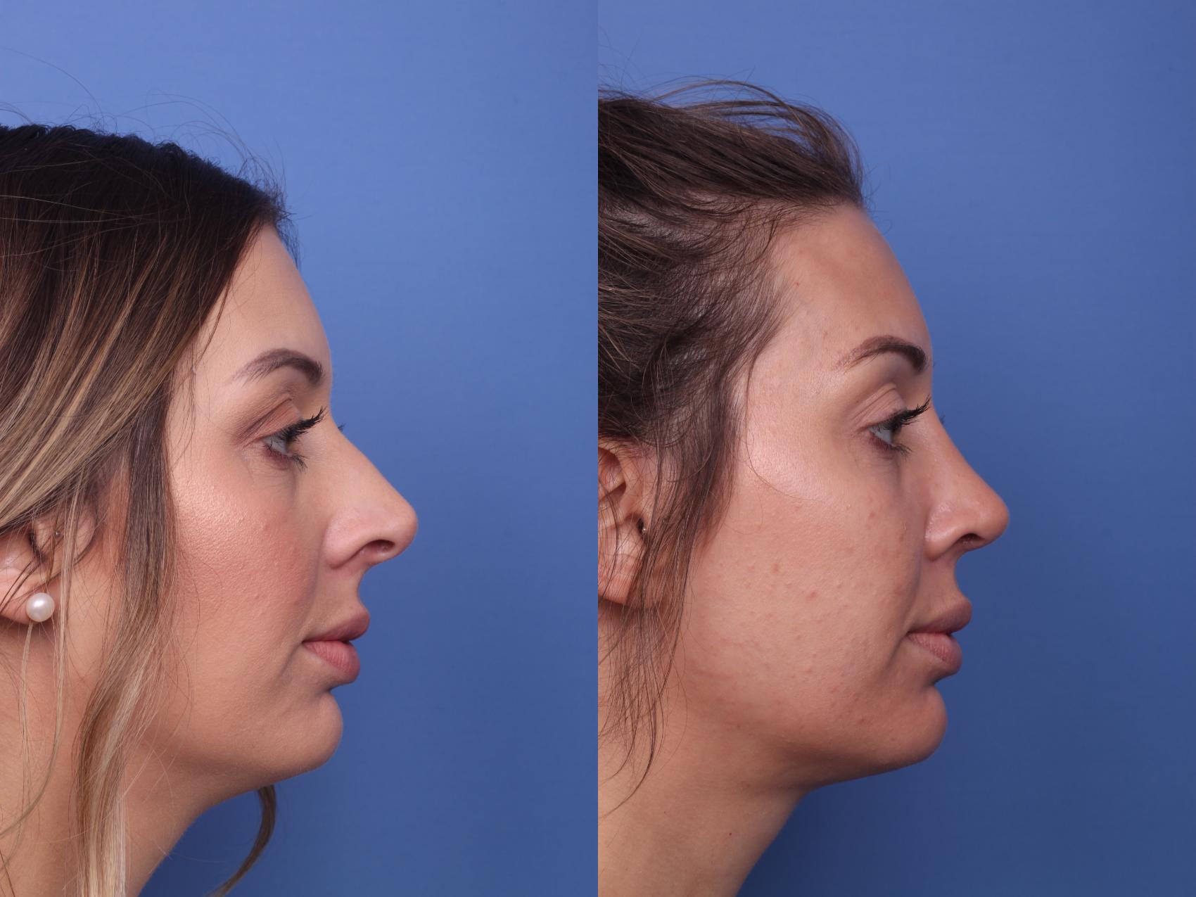 Before & After Rhinoplasty Case 187 View #2 View in Scottsdale, AZ