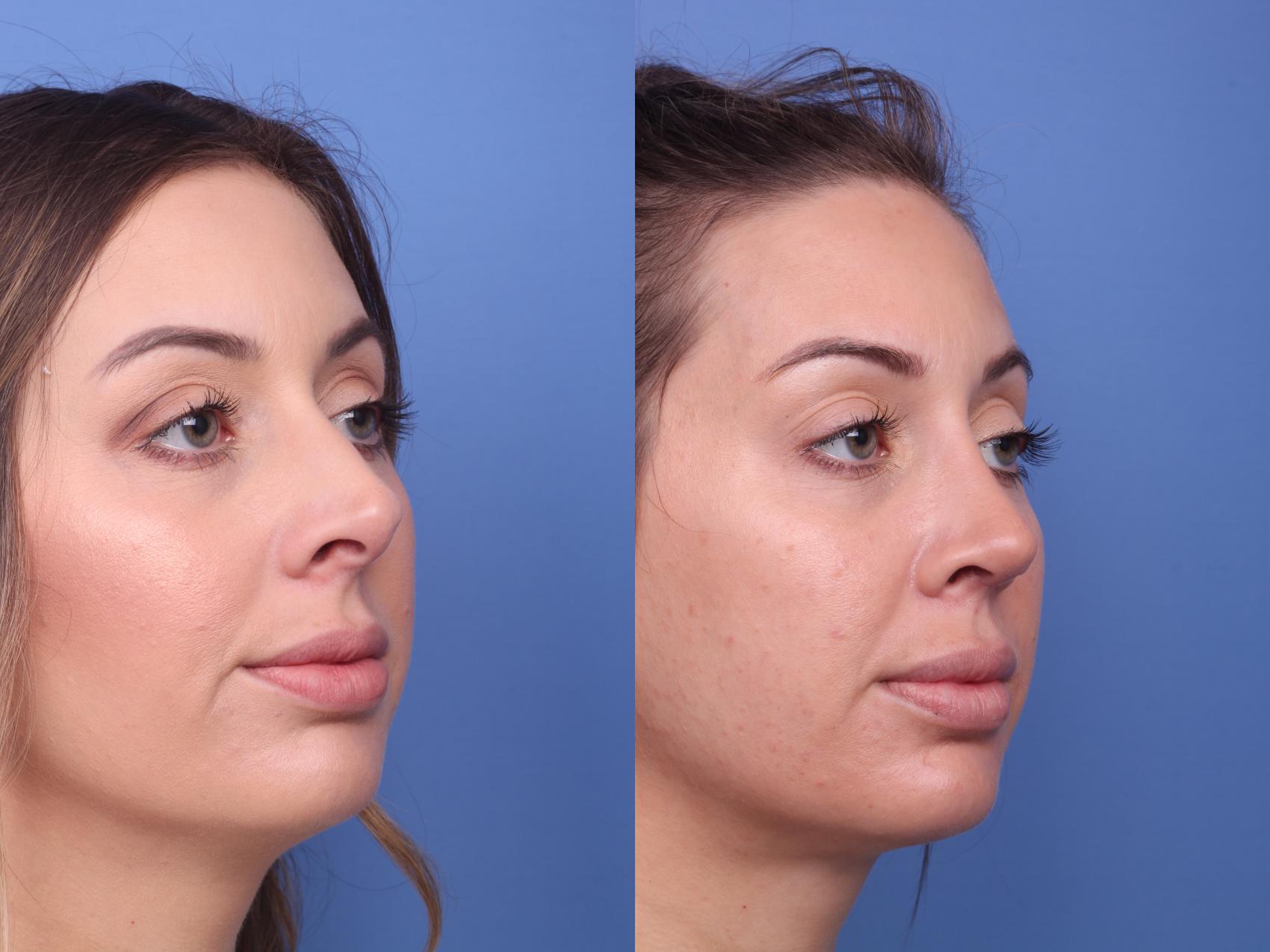 Before & After Rhinoplasty Case 187 View #3 View in Scottsdale, AZ