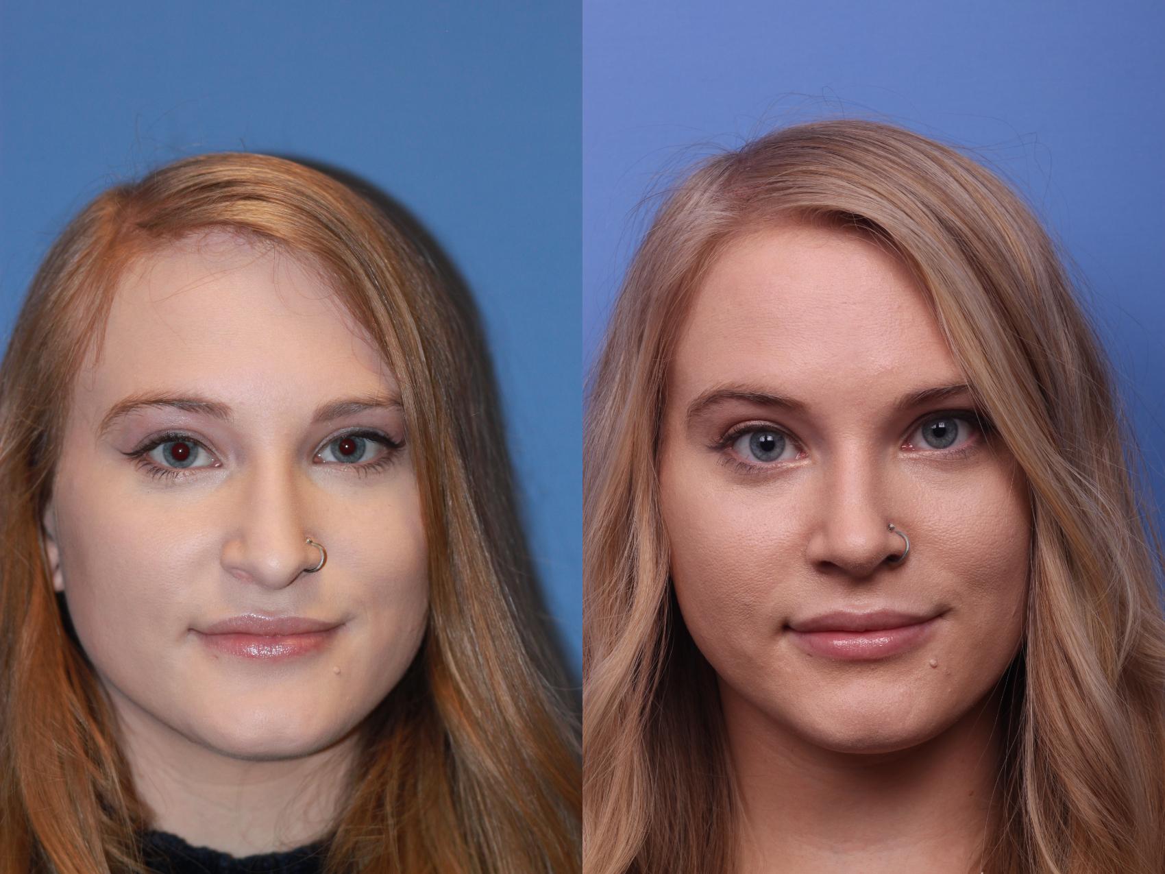 Before & After Rhinoplasty Case 188 View #1 View in Scottsdale, AZ