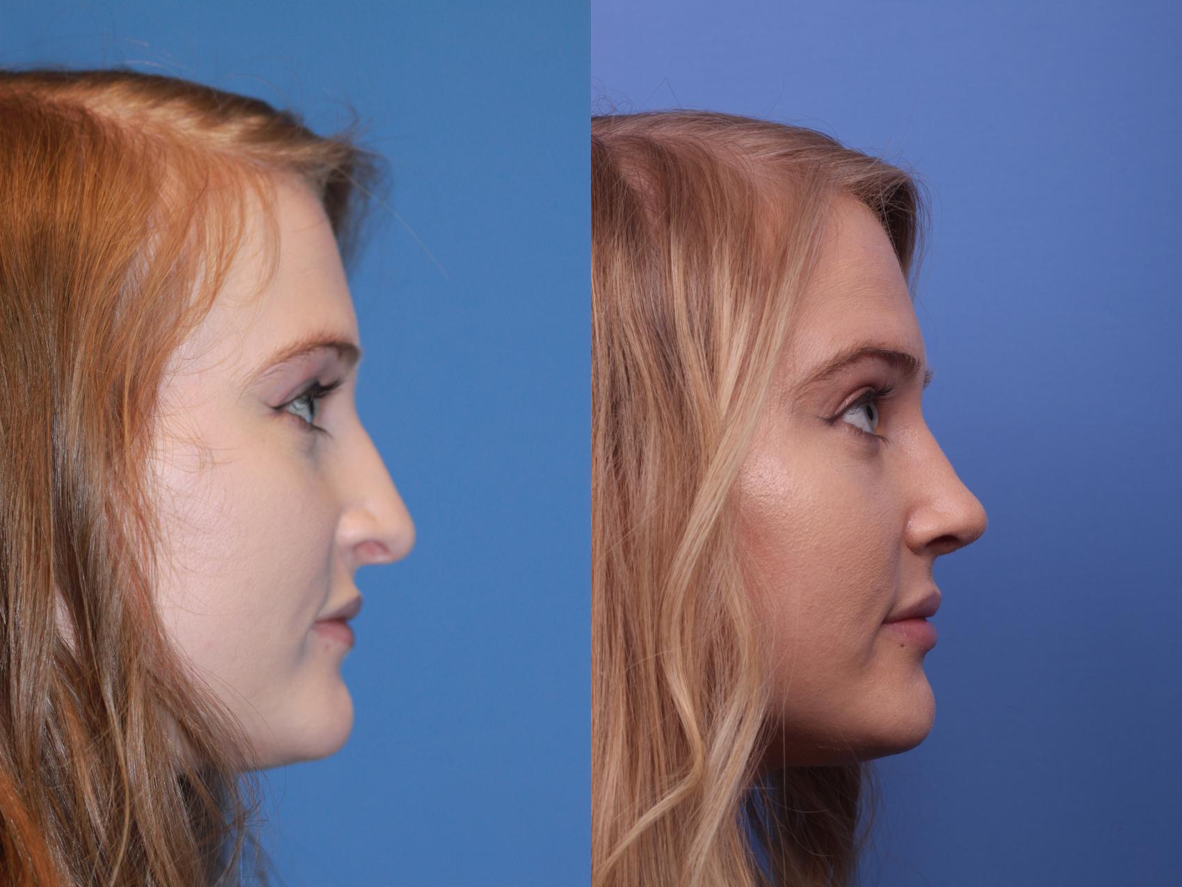 Before & After Rhinoplasty Case 188 View #2 View in Scottsdale, AZ