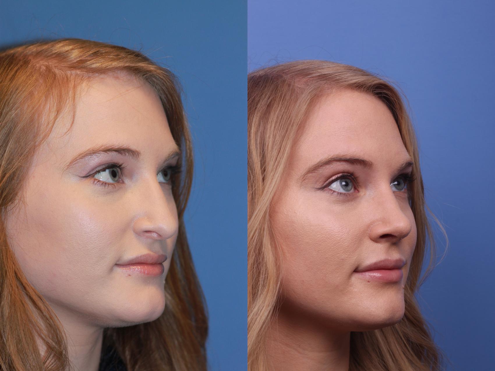 Before & After Rhinoplasty Case 188 View #3 View in Scottsdale, AZ