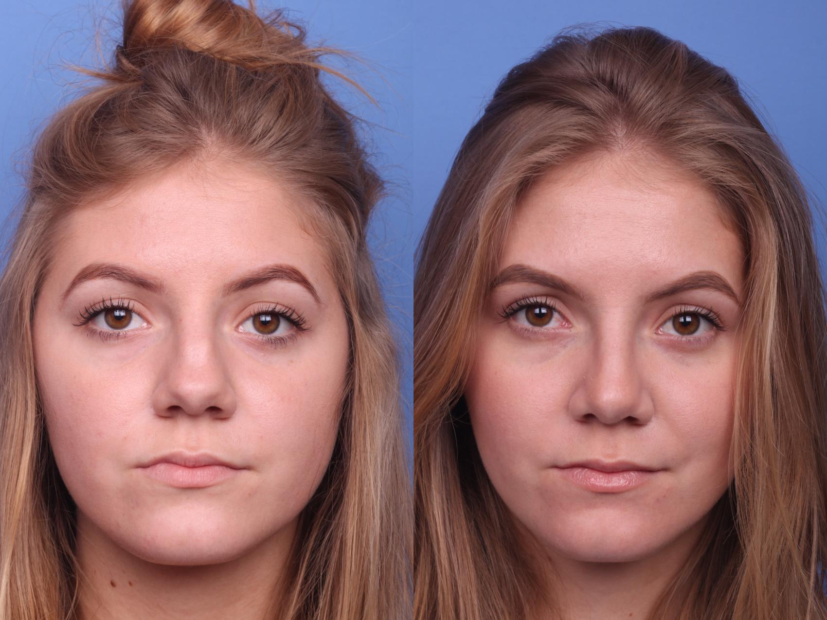 Before & After Rhinoplasty Case 189 View #1 View in Scottsdale, AZ