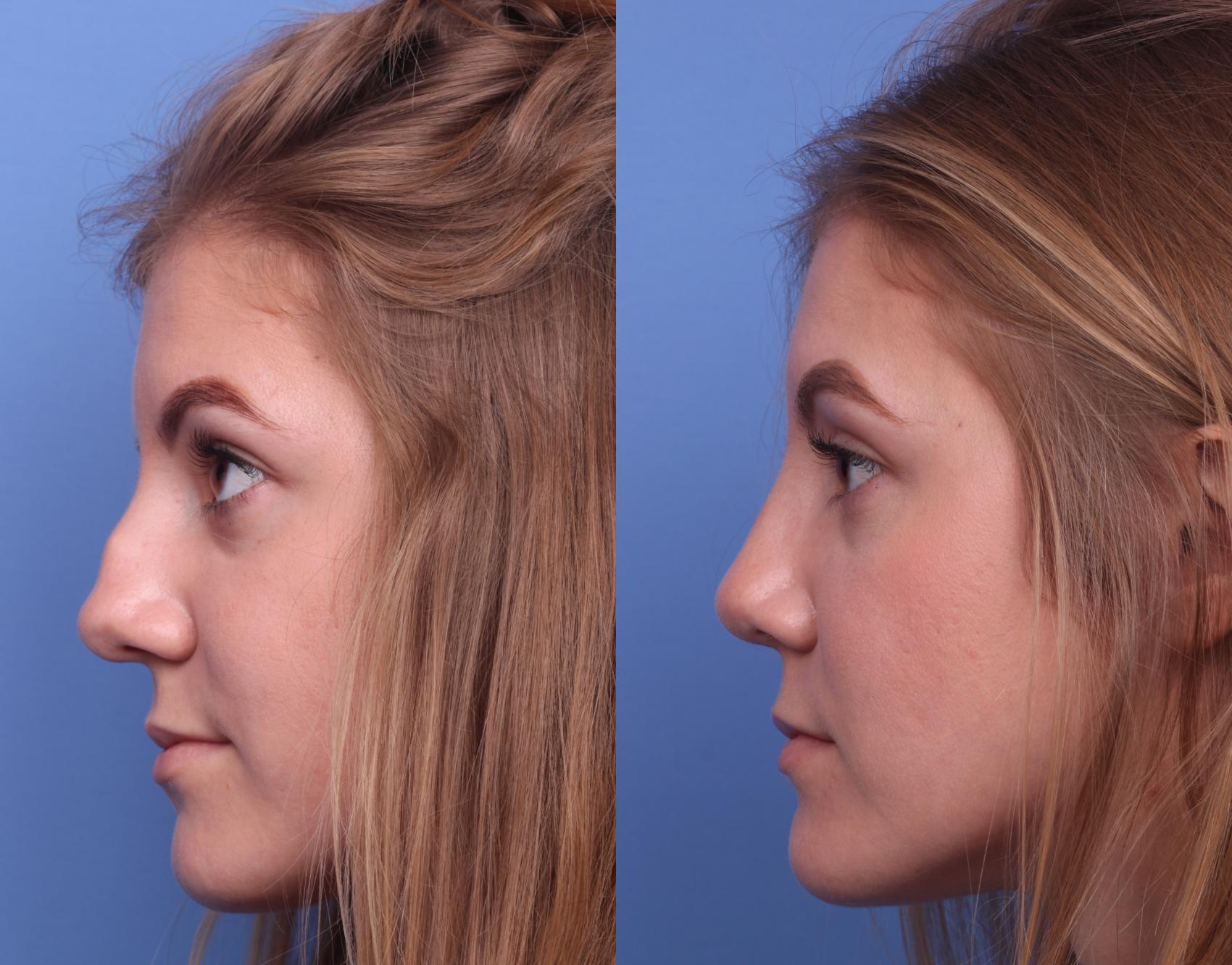 Before & After Rhinoplasty Case 189 View #2 View in Scottsdale, AZ