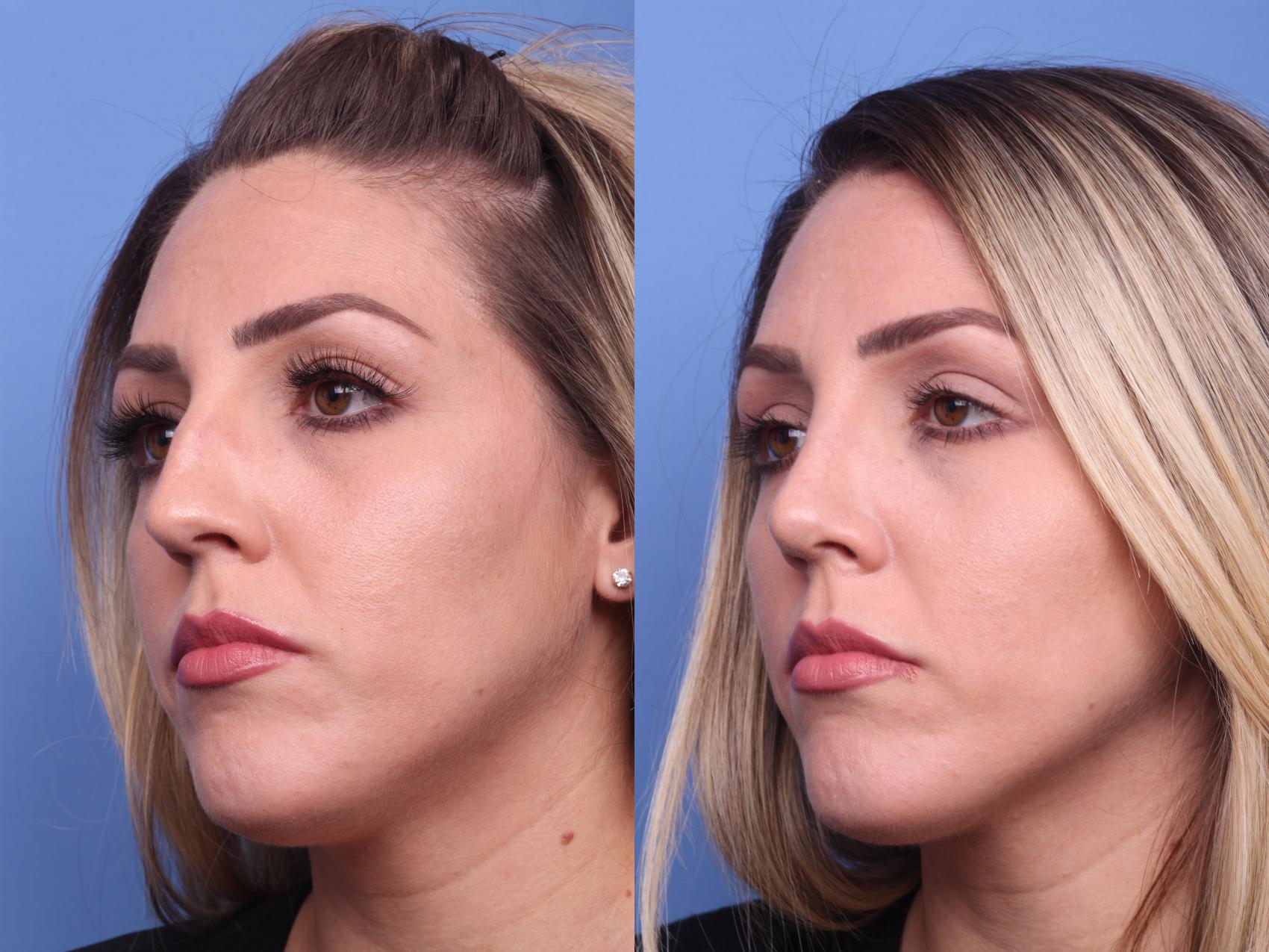 Before & After Rhinoplasty Case 192 View #2 View in Scottsdale, AZ