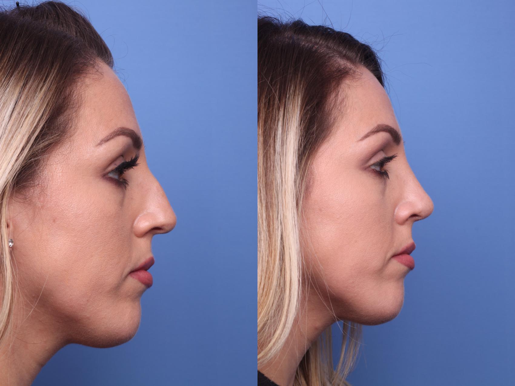 Before & After Rhinoplasty Case 192 View #3 View in Scottsdale, AZ