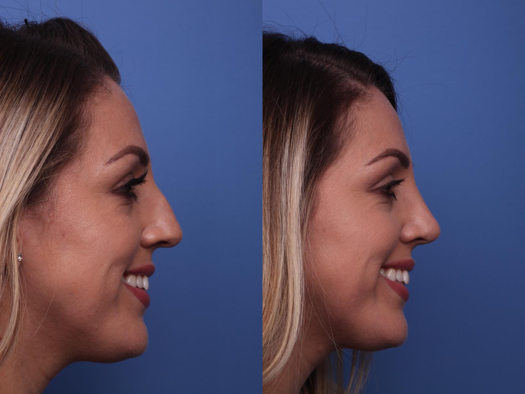 Before & After Rhinoplasty Case 192 View #4 View in Scottsdale, AZ
