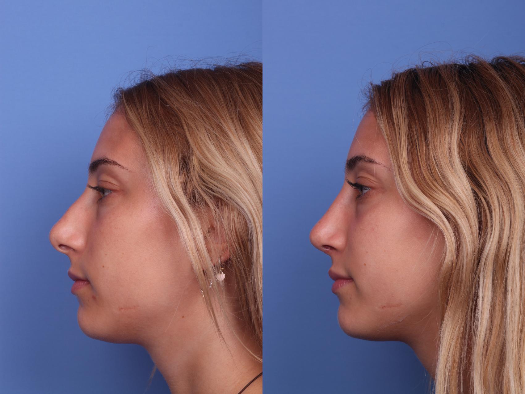 Before & After Rhinoplasty Case 195 View #2 View in Scottsdale, AZ
