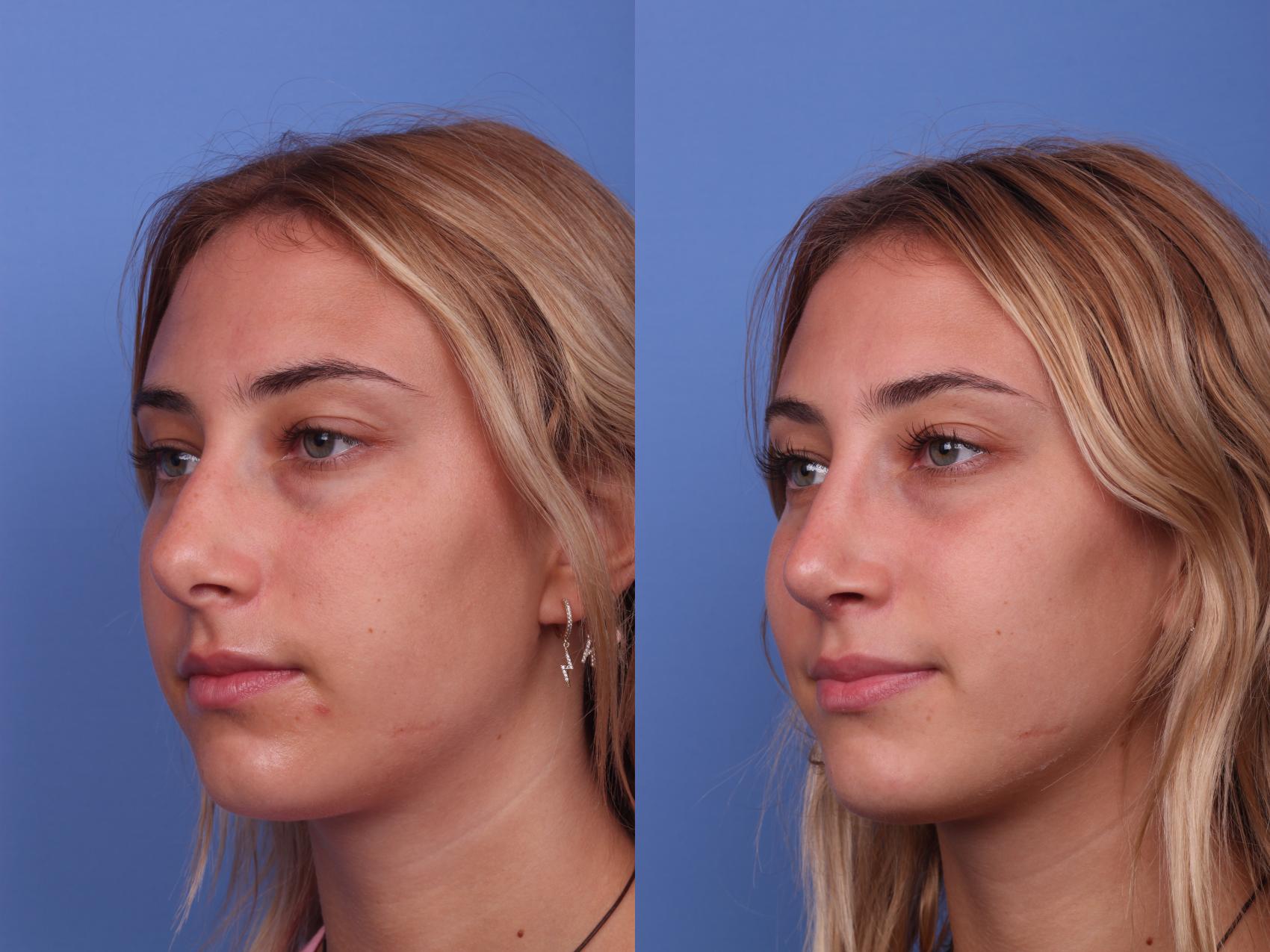 Before & After Rhinoplasty Case 195 View #3 View in Scottsdale, AZ
