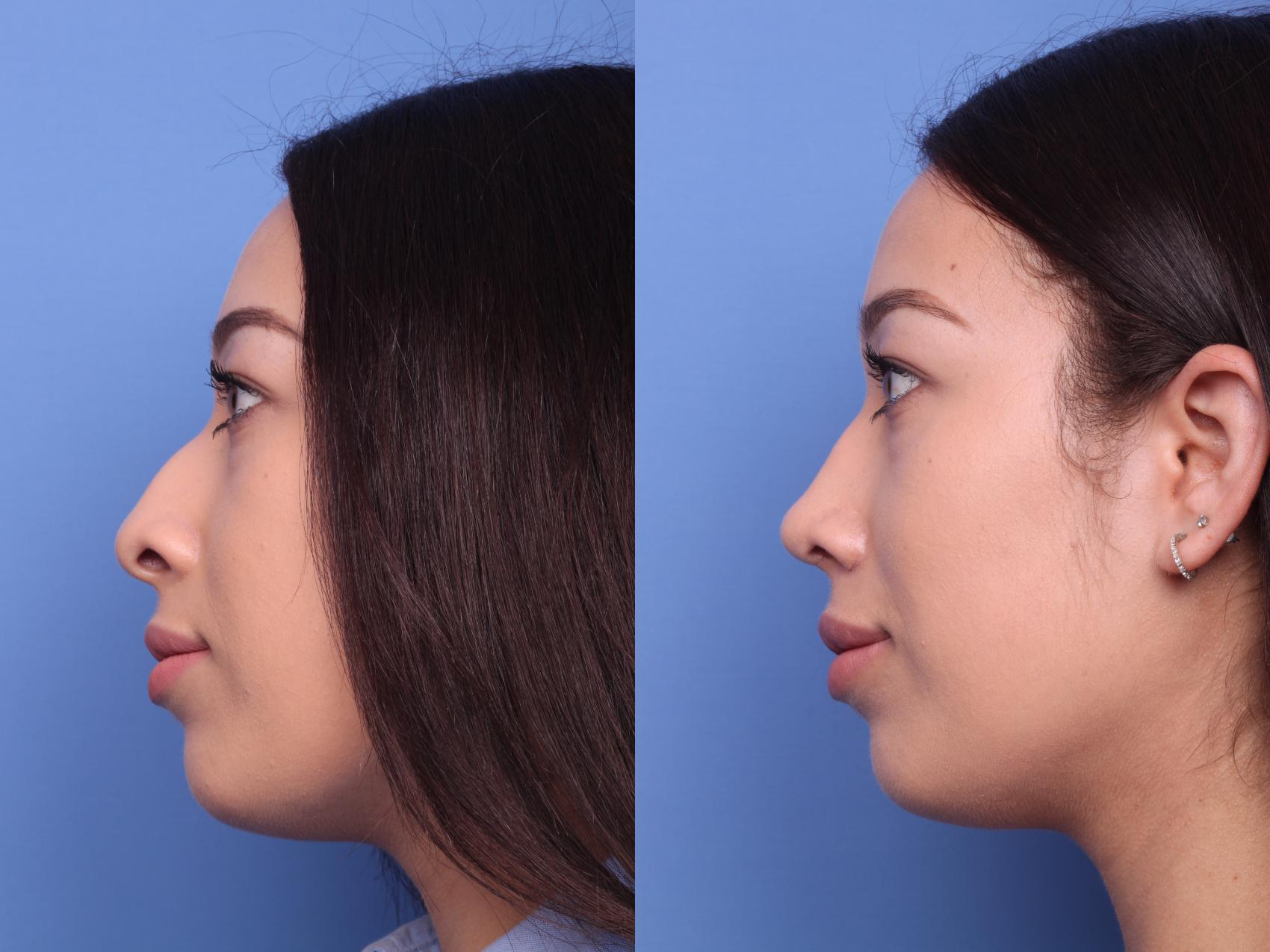 Before & After Rhinoplasty Case 196 View #2 View in Scottsdale, AZ