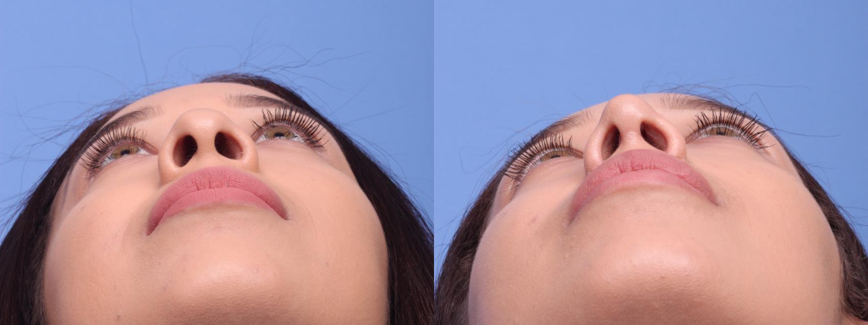 Before & After Rhinoplasty Case 196 View #3 View in Scottsdale, AZ