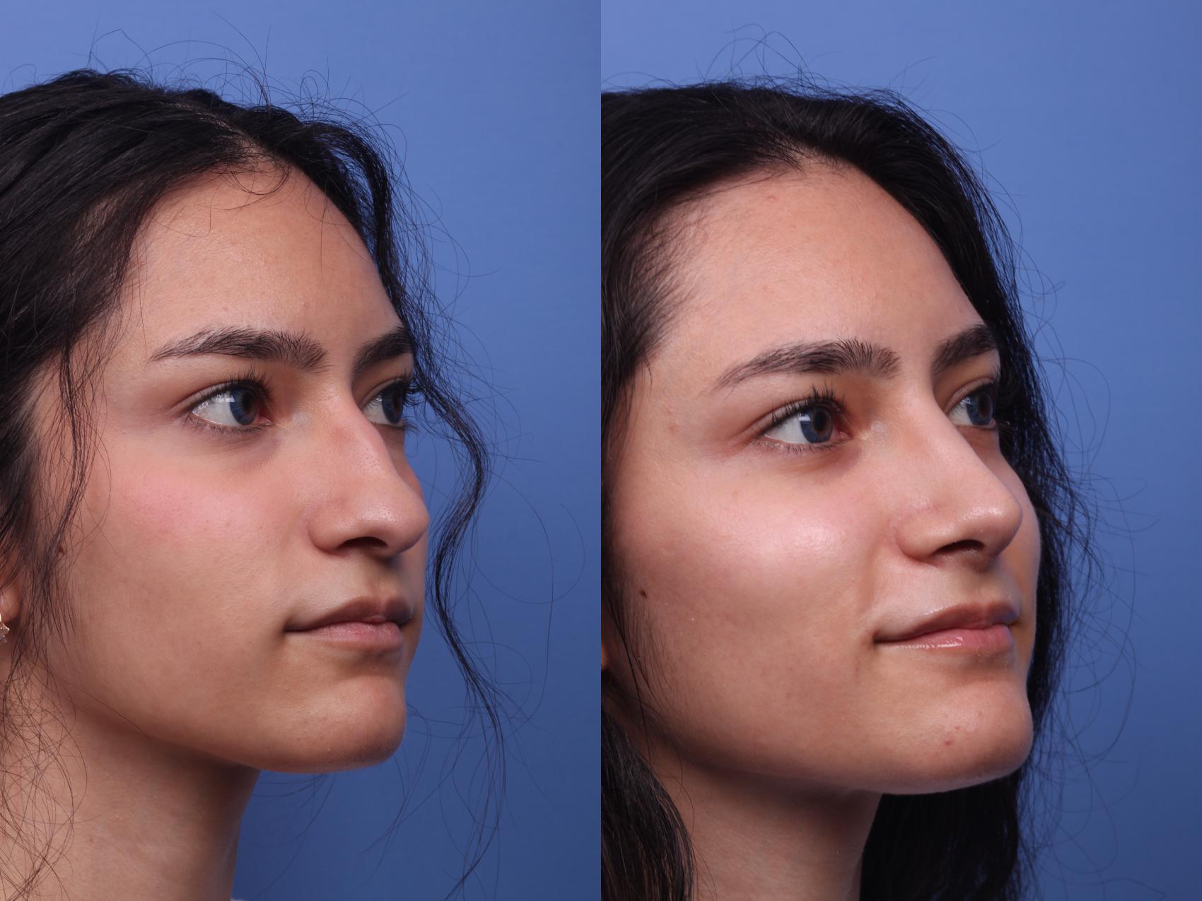 Before & After Rhinoplasty Case 198 View #2 View in Scottsdale, AZ