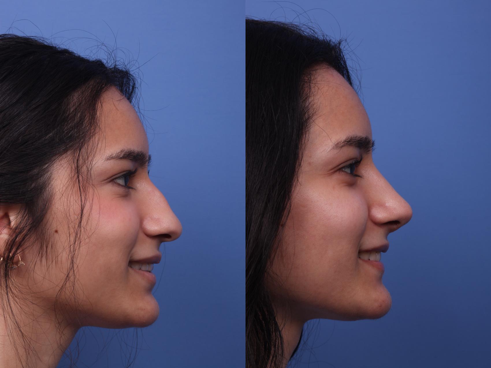 Before & After Rhinoplasty Case 198 View #3 View in Scottsdale, AZ