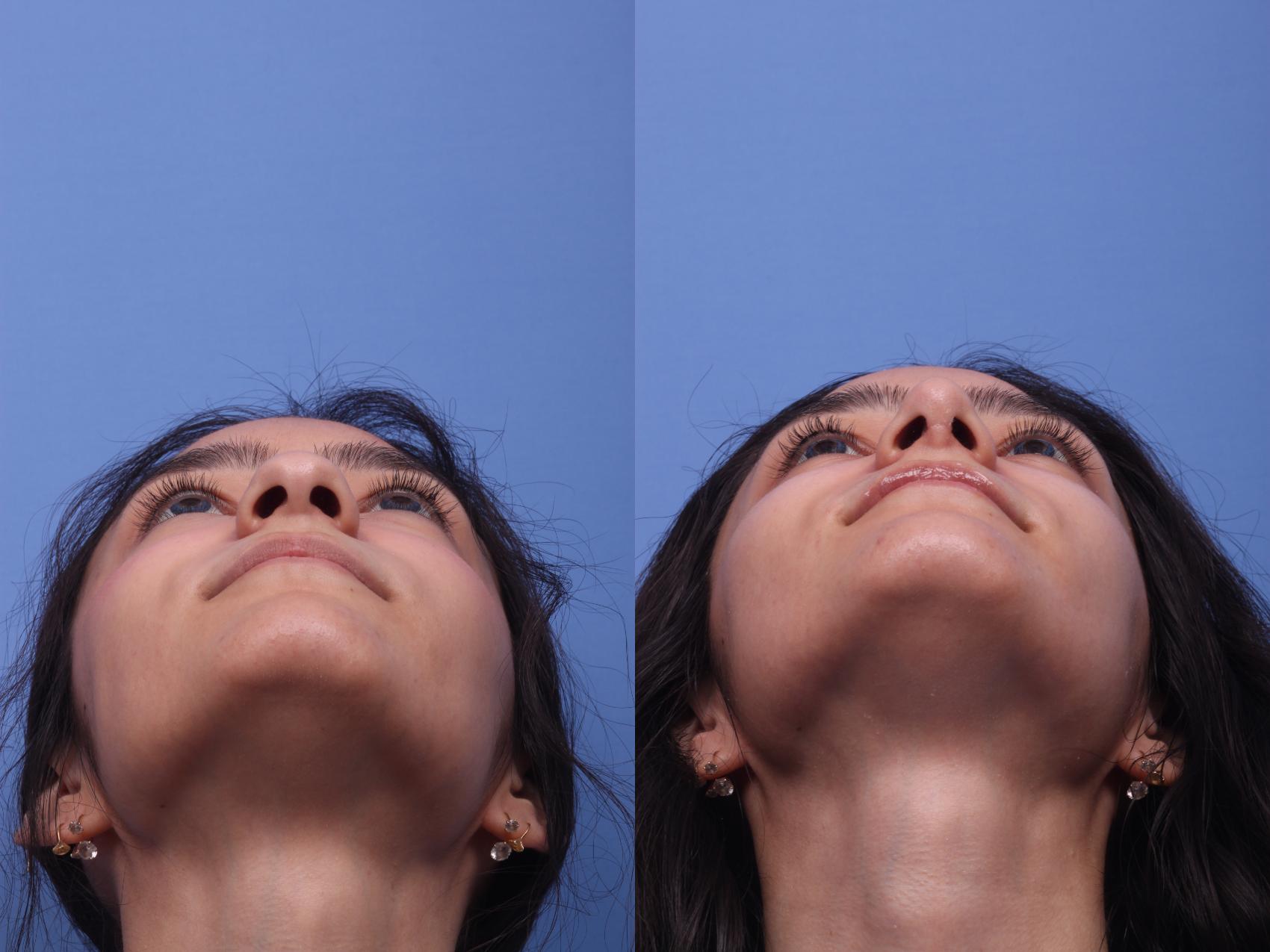 Before & After Rhinoplasty Case 198 View #4 View in Scottsdale, AZ