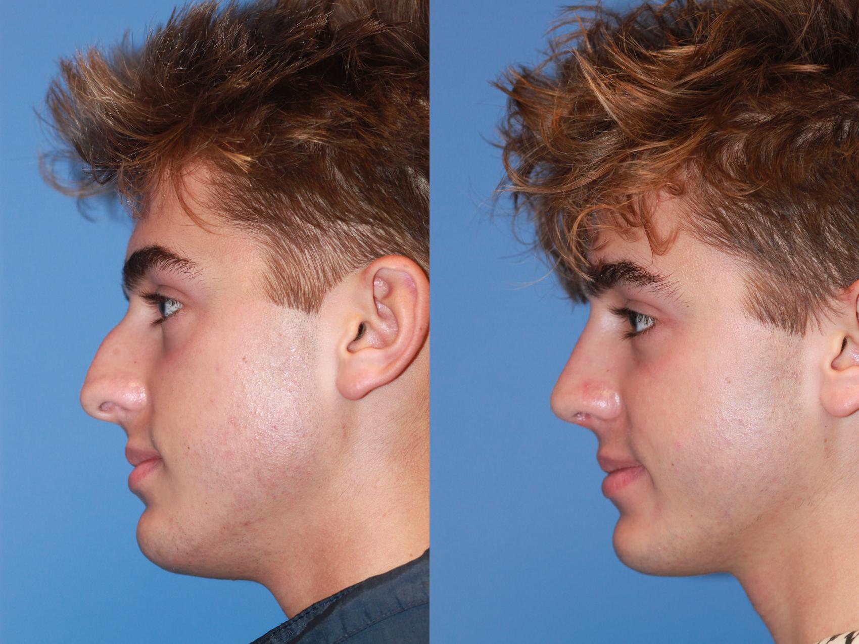 Before & After Rhinoplasty Case 199 View #3 View in Scottsdale, AZ
