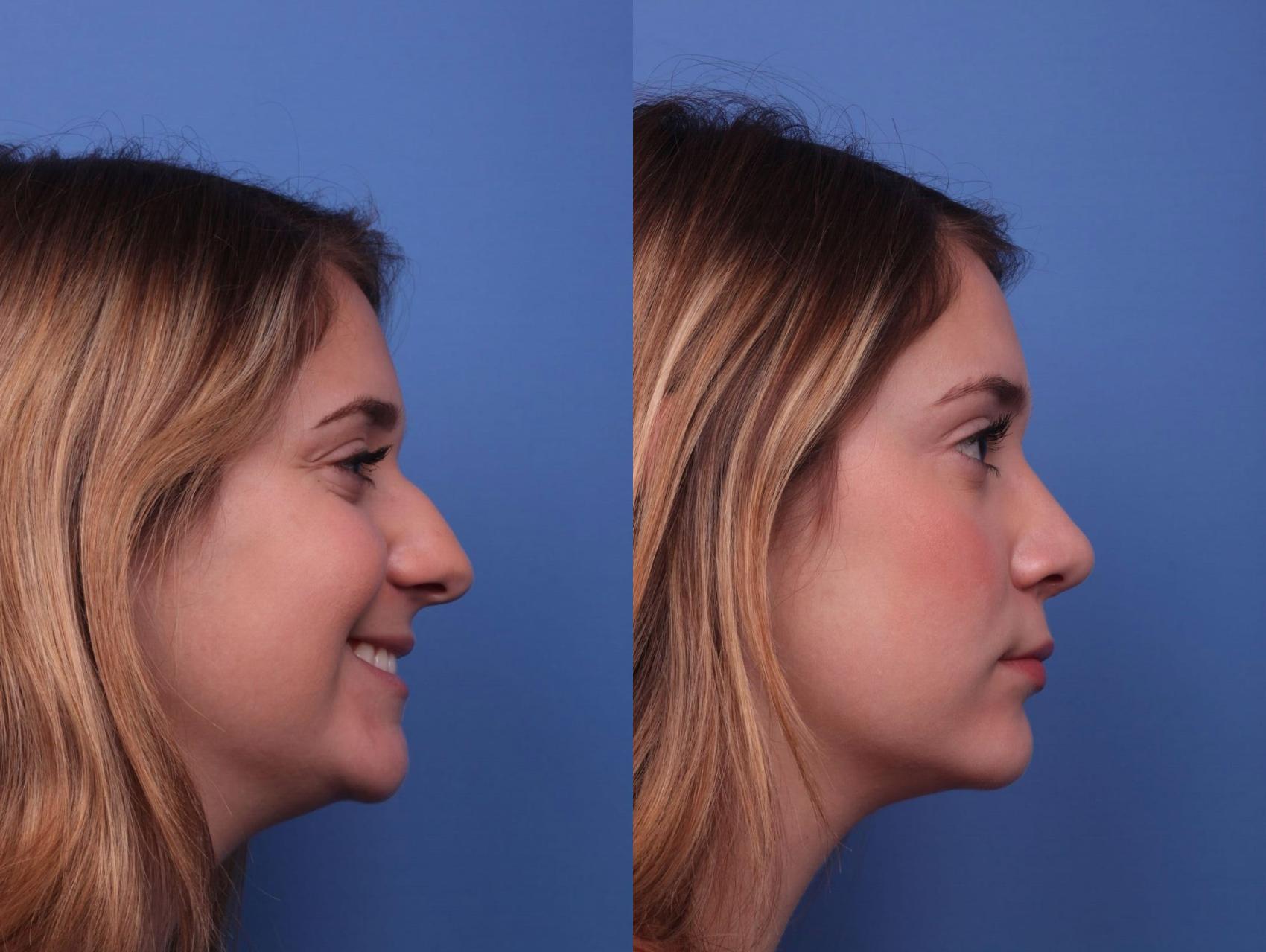 Before & After Rhinoplasty Case 20 View #2 View in Scottsdale, AZ