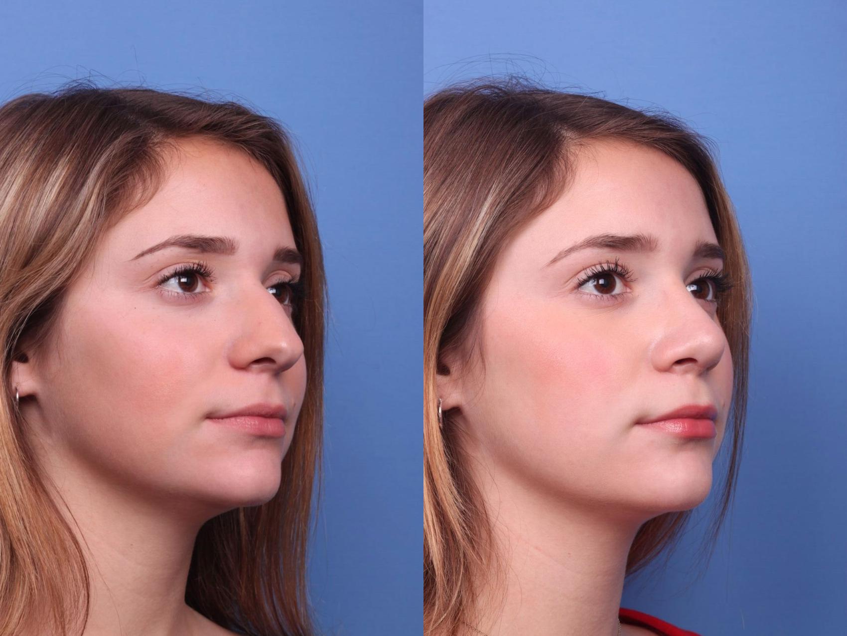 Before & After Rhinoplasty Case 20 View #3 View in Scottsdale, AZ