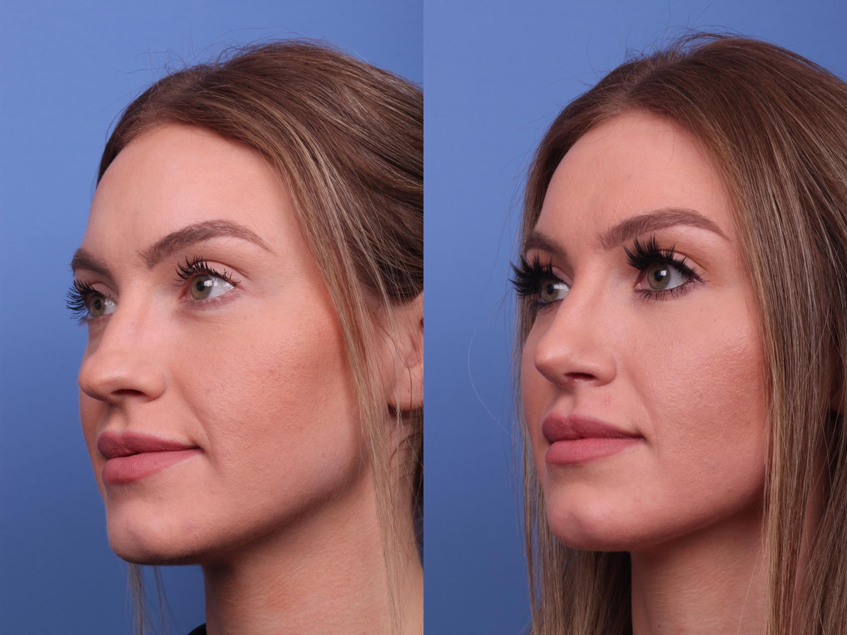 Before & After Rhinoplasty Case 200 View #2 View in Scottsdale, AZ