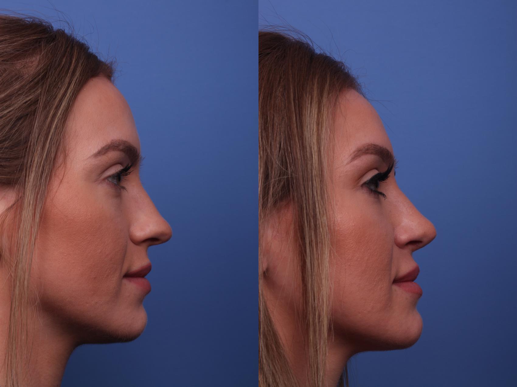 Before & After Rhinoplasty Case 200 View #3 View in Scottsdale, AZ