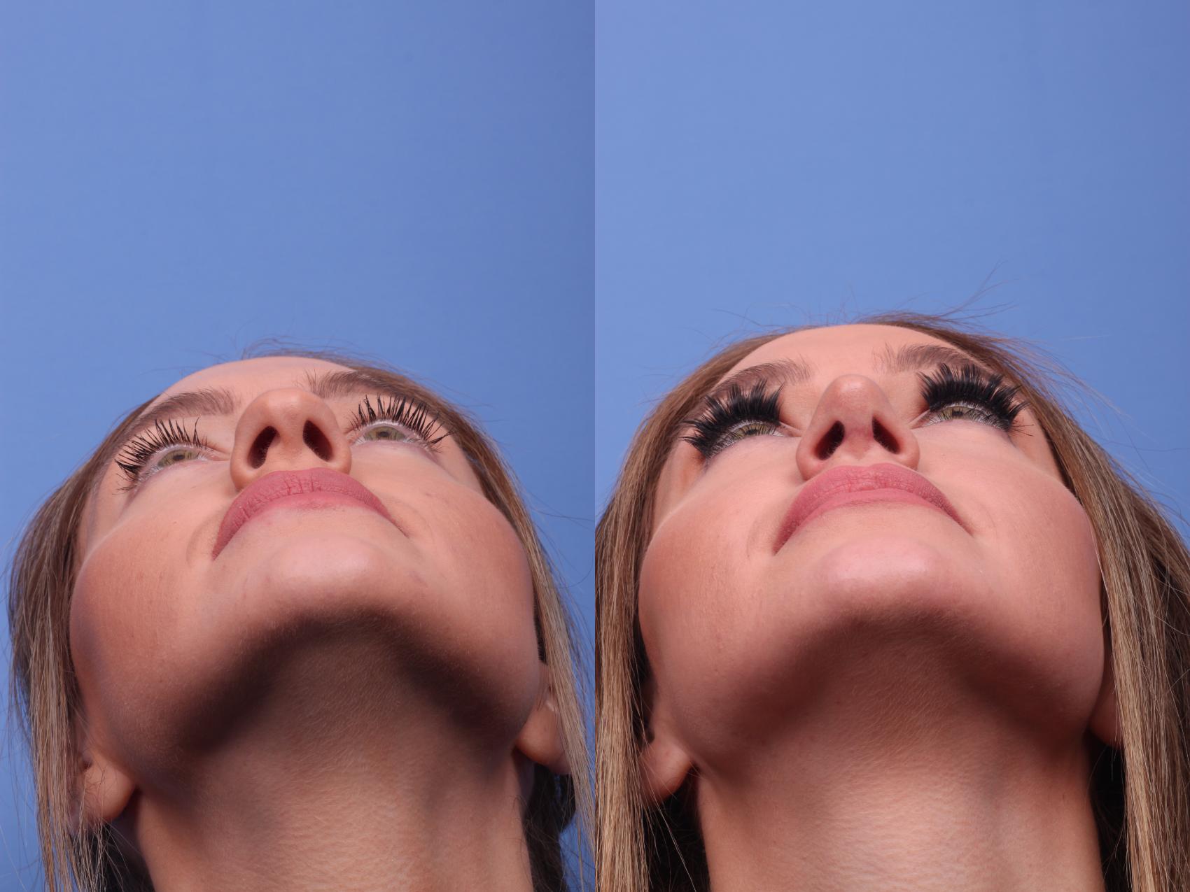 Before & After Rhinoplasty Case 200 View #4 View in Scottsdale, AZ