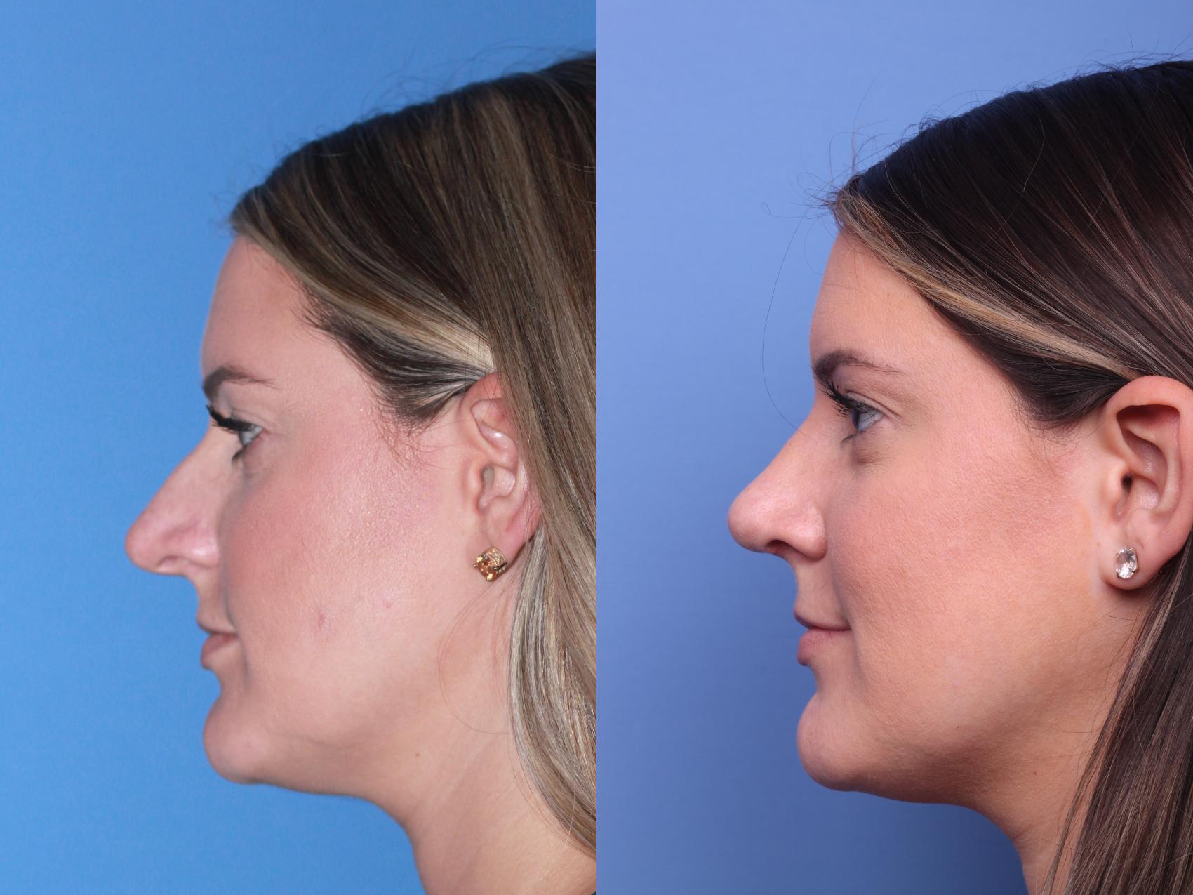 Before & After Rhinoplasty Case 201 View #2 View in Scottsdale, AZ