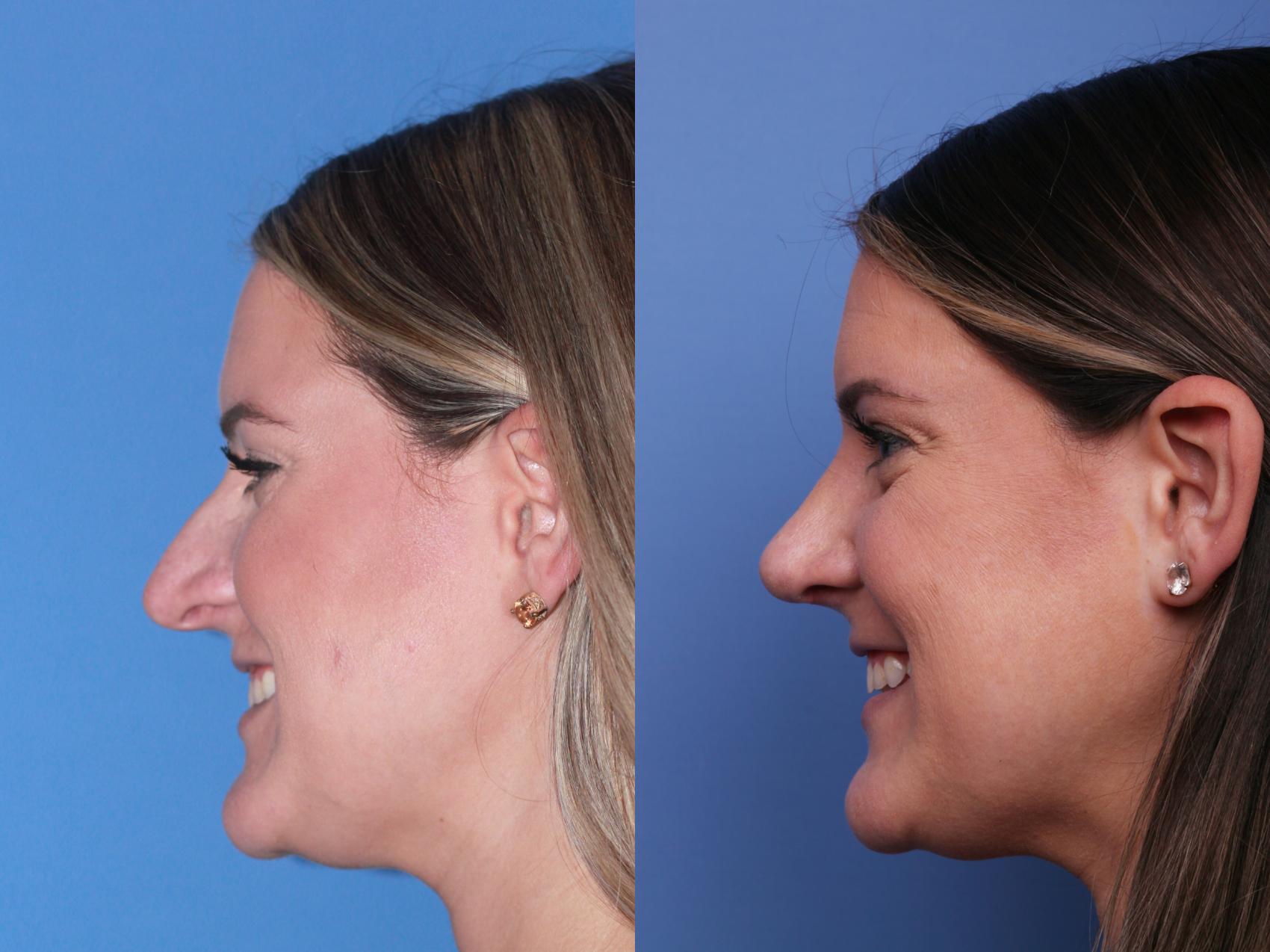 Before & After Rhinoplasty Case 201 View #3 View in Scottsdale, AZ