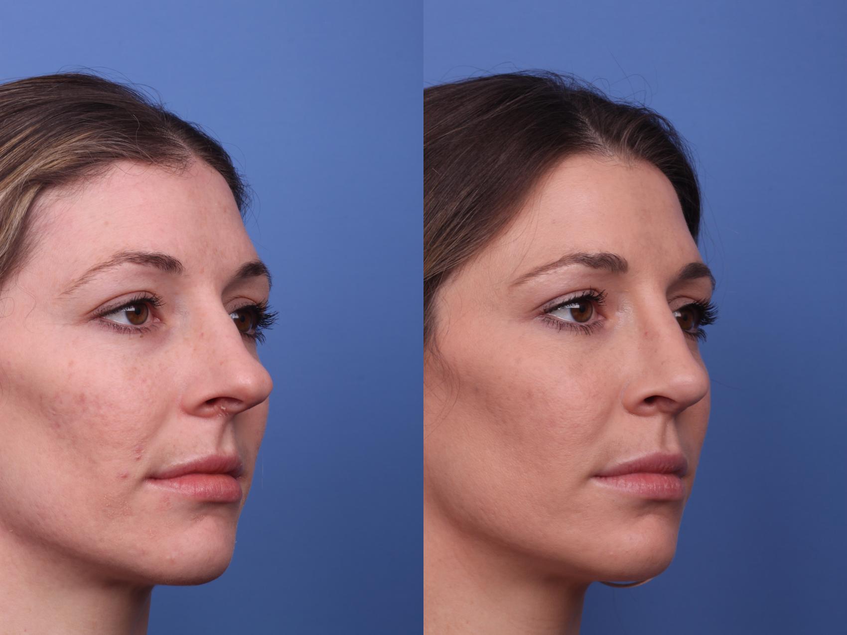 Before & After Rhinoplasty Case 202 View #2 View in Scottsdale, AZ