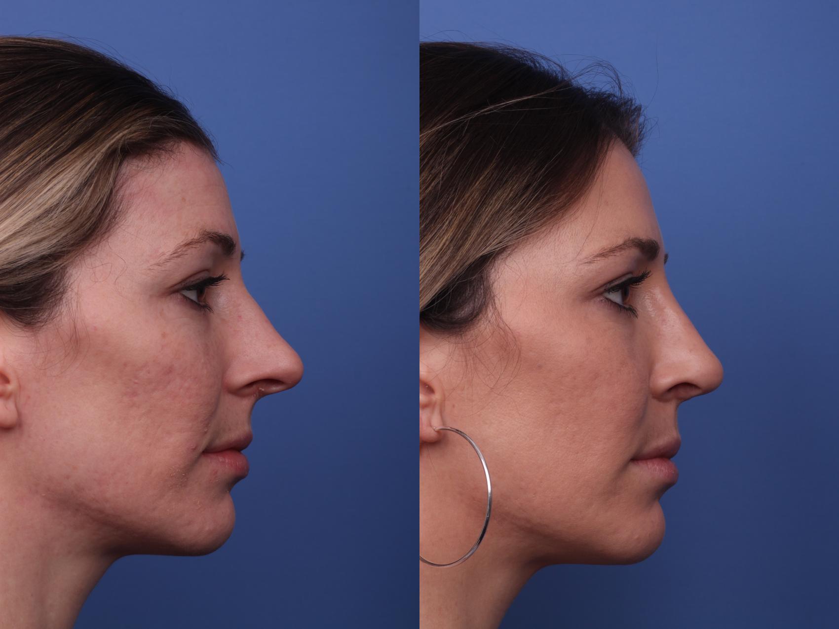 Before & After Rhinoplasty Case 202 View #3 View in Scottsdale, AZ