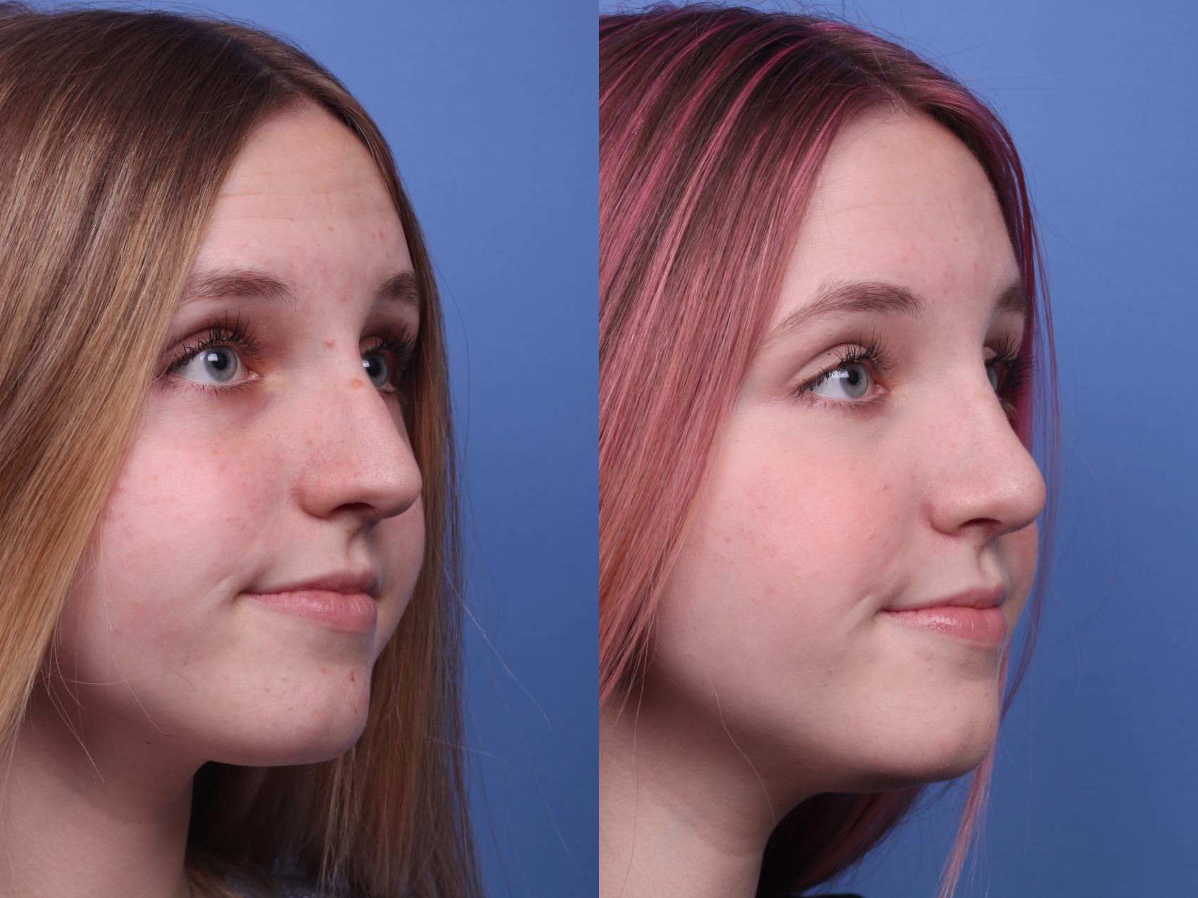 Before & After Rhinoplasty Case 203 View #2 View in Scottsdale, AZ