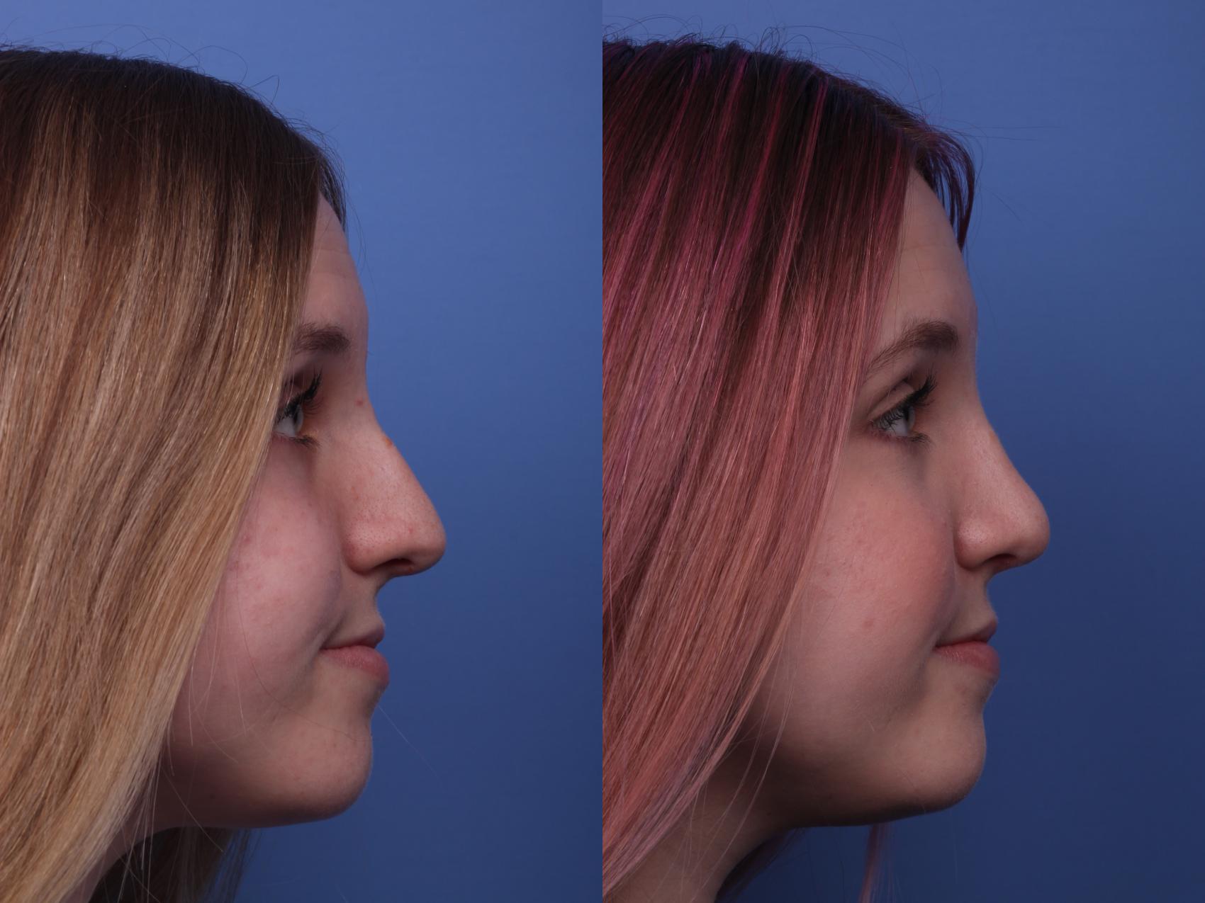 Before & After Rhinoplasty Case 203 View #3 View in Scottsdale, AZ