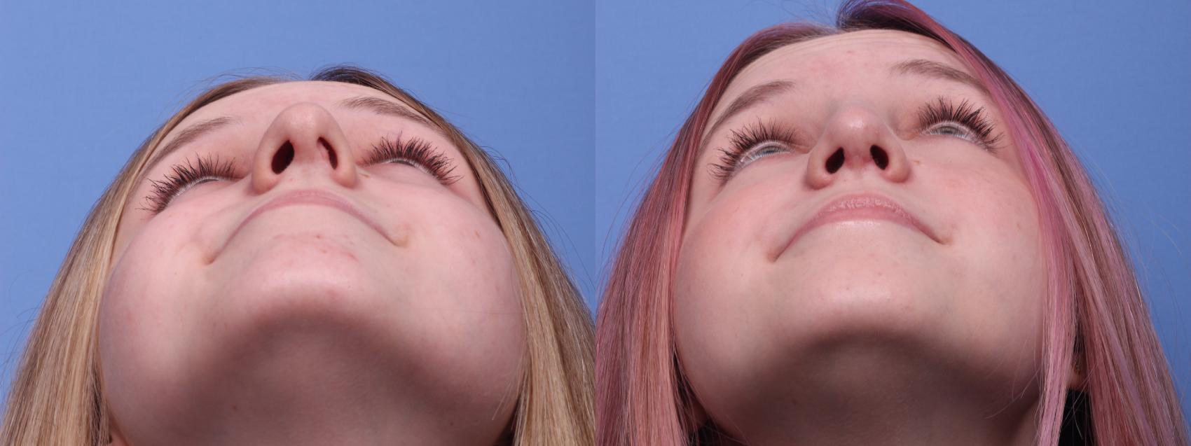 Before & After Rhinoplasty Case 203 View #4 View in Scottsdale, AZ